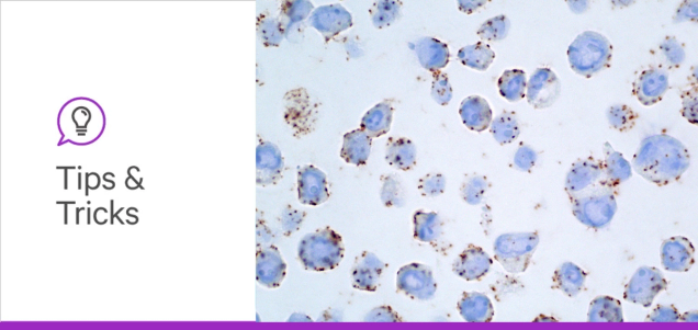 A New Focus for Breast Cancer: Protein Glycosylation’s Emerging Role