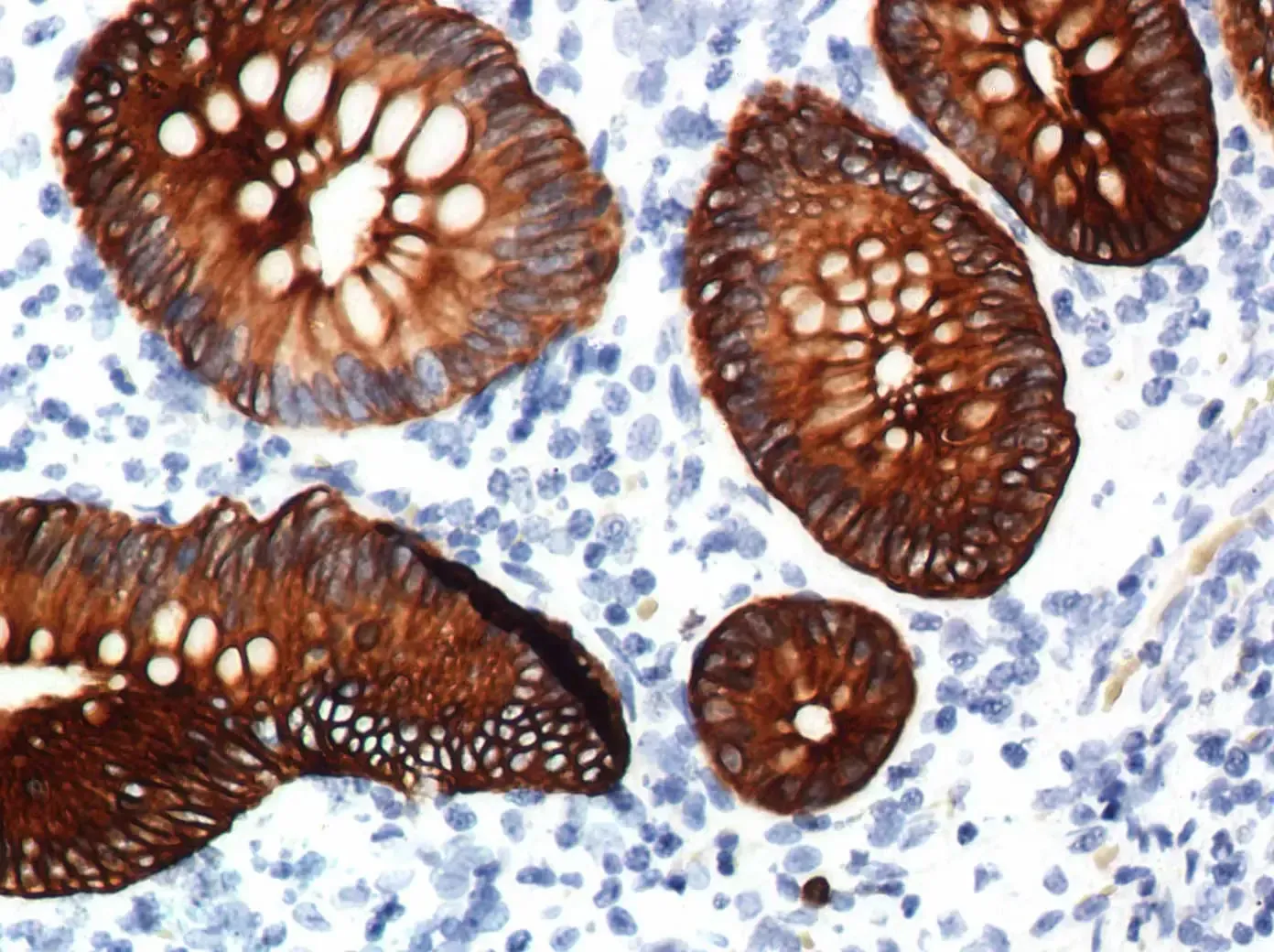 LuAiling intestines Cytokeratin 19 DAB LuAiling intestines Cytokeratin 19 DAB