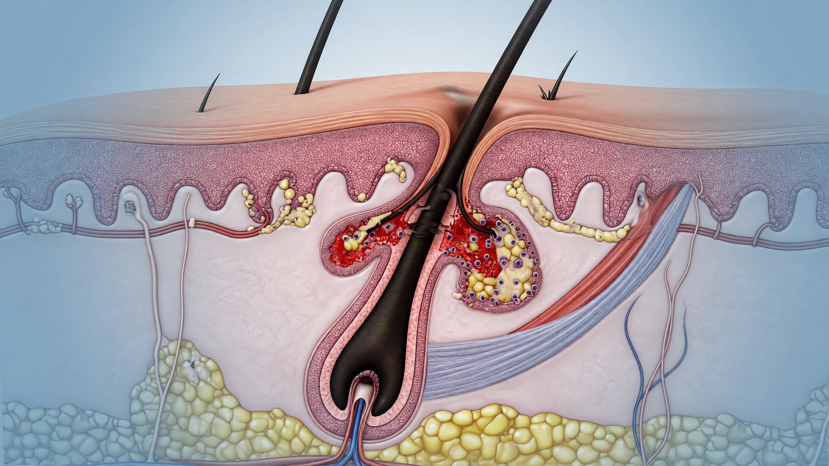 Diagram illustrating pilonidal sinus causes near the tailbone with ingrown hair