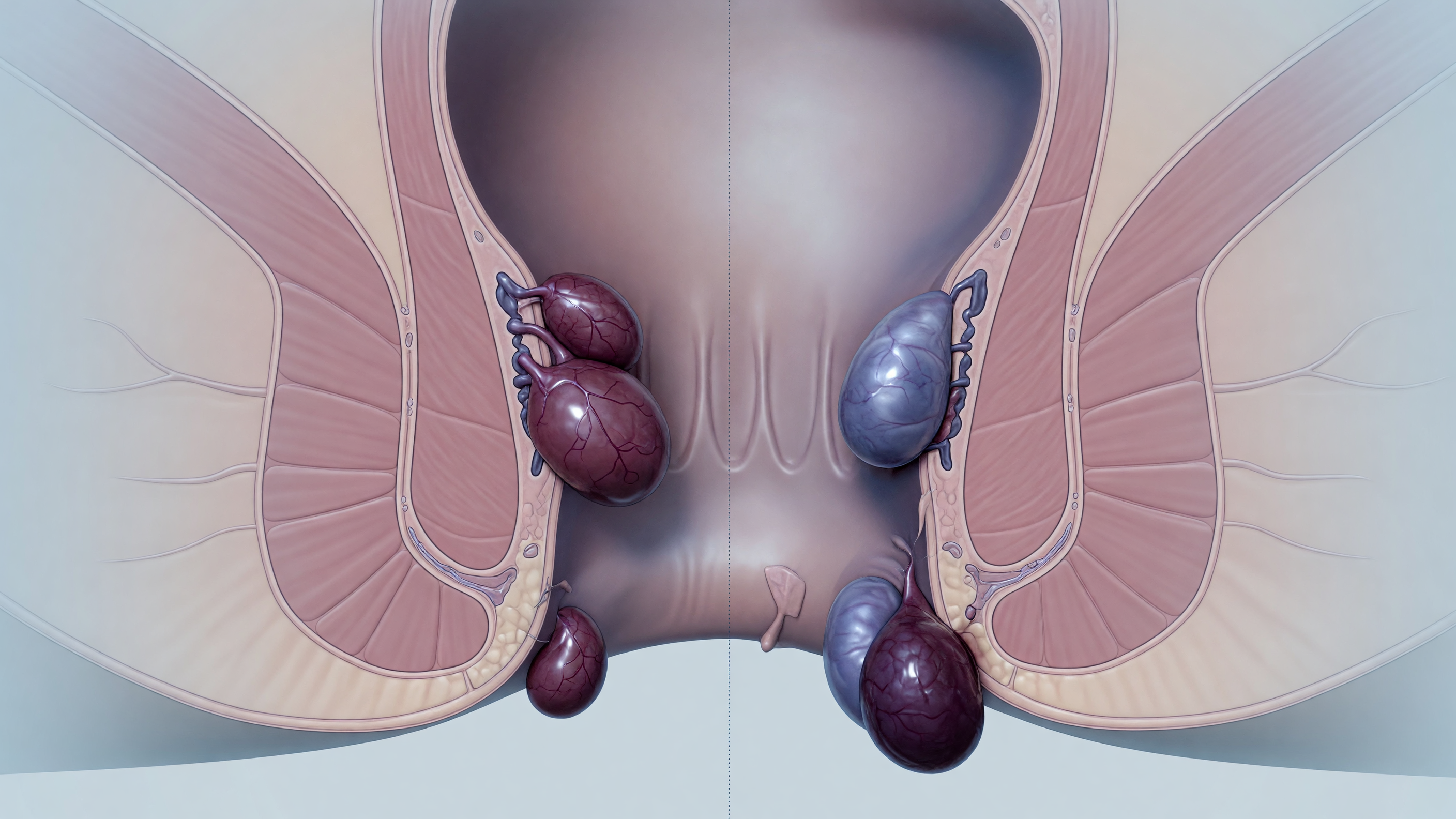 Medical illustration showing internal vs external piles location and symptoms in the anal region
