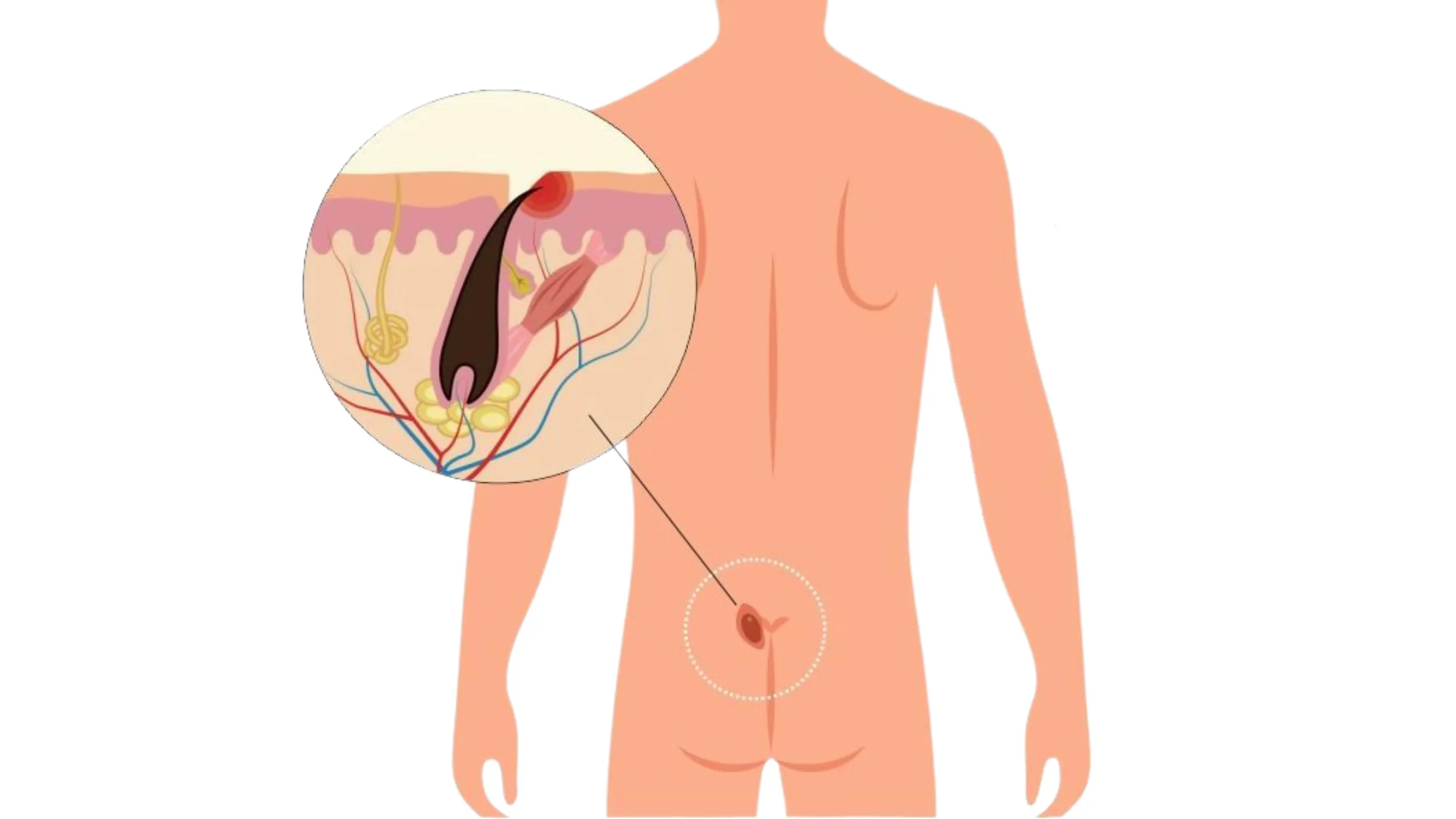 Pilonidal Sinus