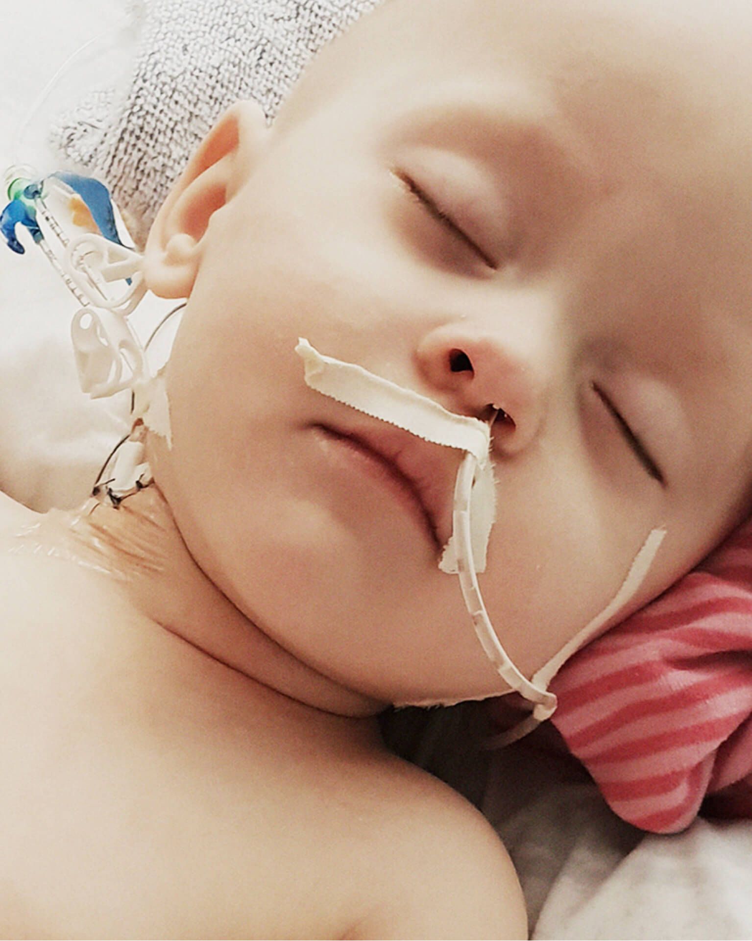 A sleeping infant with hospital heart-monitoring leads and nasal tape, head resting on a striped blanket.