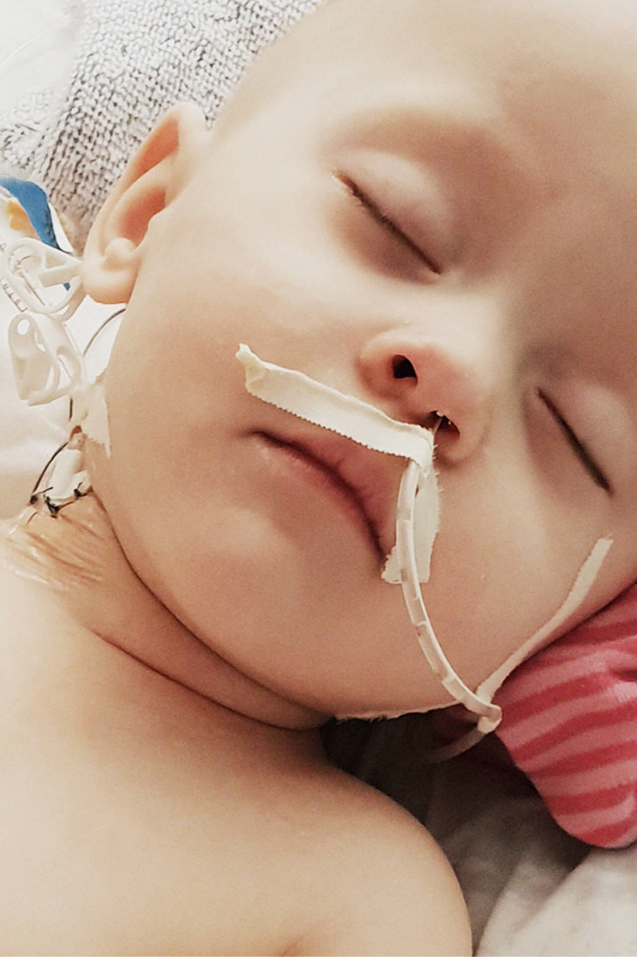 A sleeping infant with hospital heart-monitoring leads and nasal tape, head resting on a striped blanket.