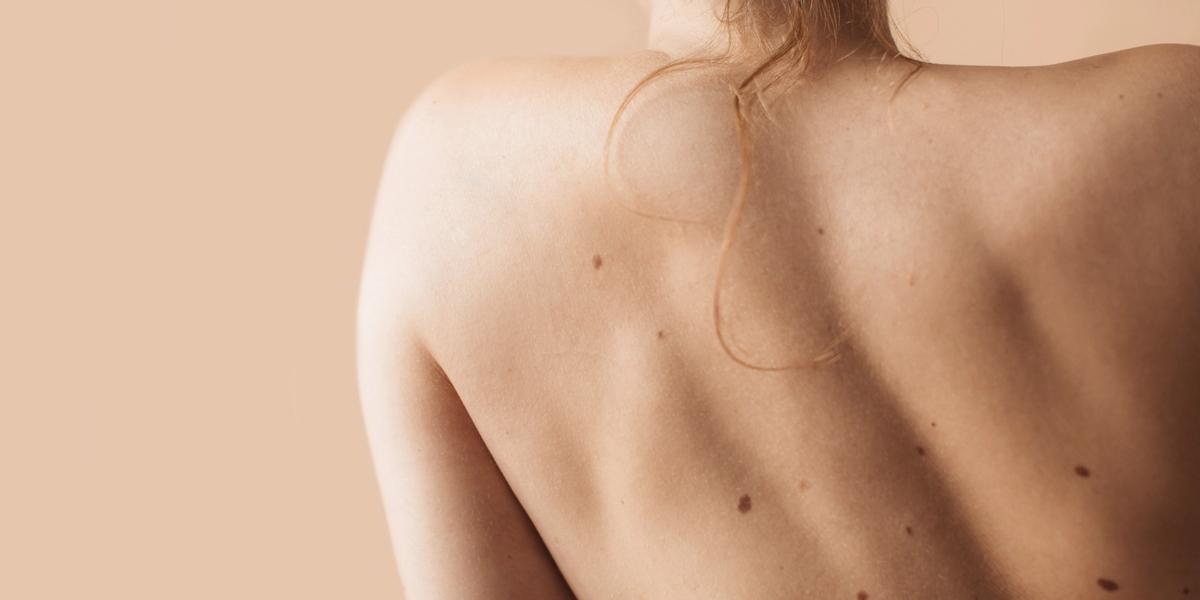 Skin Check Bondi Junction, Randwick, Mosman and Sydney CBD