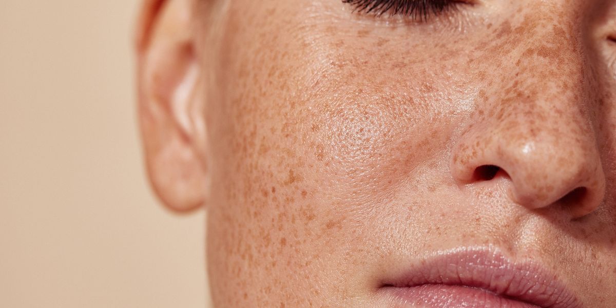Skin Cancer on the Face: Why Is It So Common?