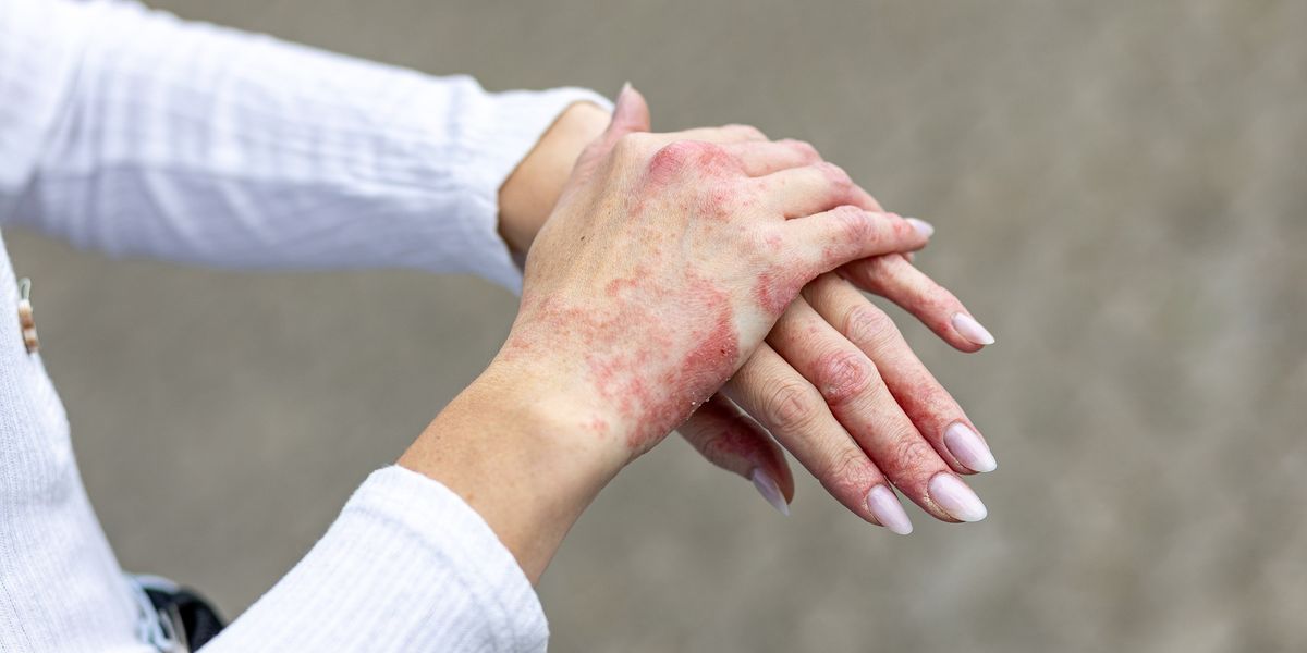 Common Skin Conditions - DermScreen Skin Health Check Sydney