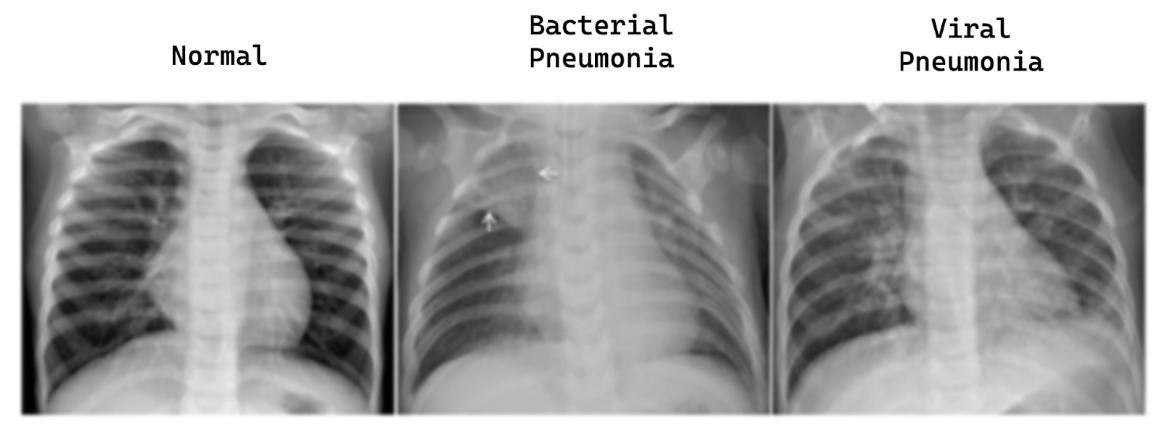 Machine learning project for detecting pneumonia