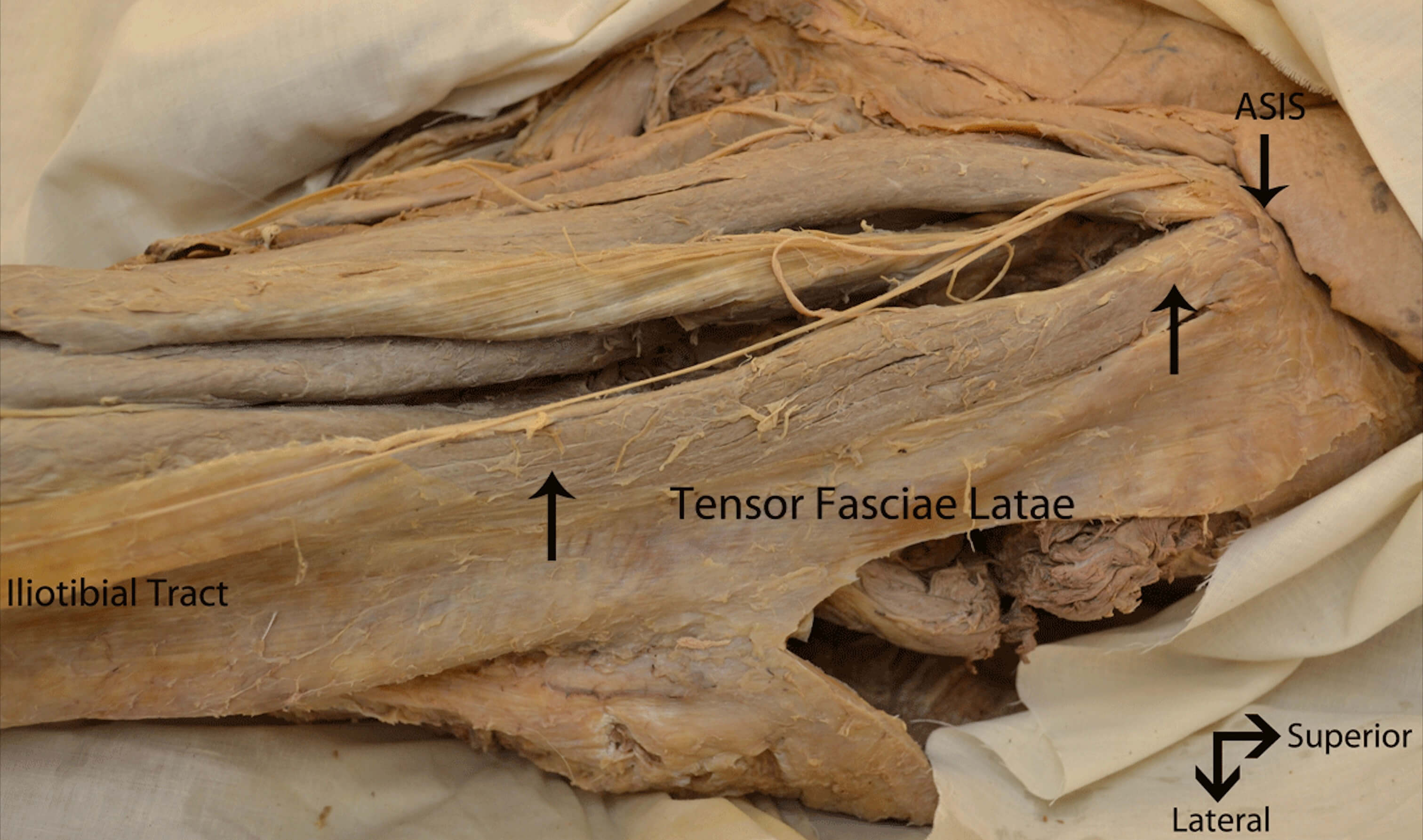 Tensor fascia lata: iliac crest, ASIS (origin) lateral condyle of tibia  (insertion). Action: abduct &…
