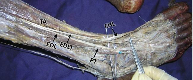 Deep Neck Flexors (Longus Colli, Longus Capitis, Rectus Capitis Anterior  and Rectus Capitis Lateralis)