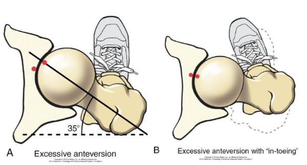 Femoral Anteversion - Brookbush Institute