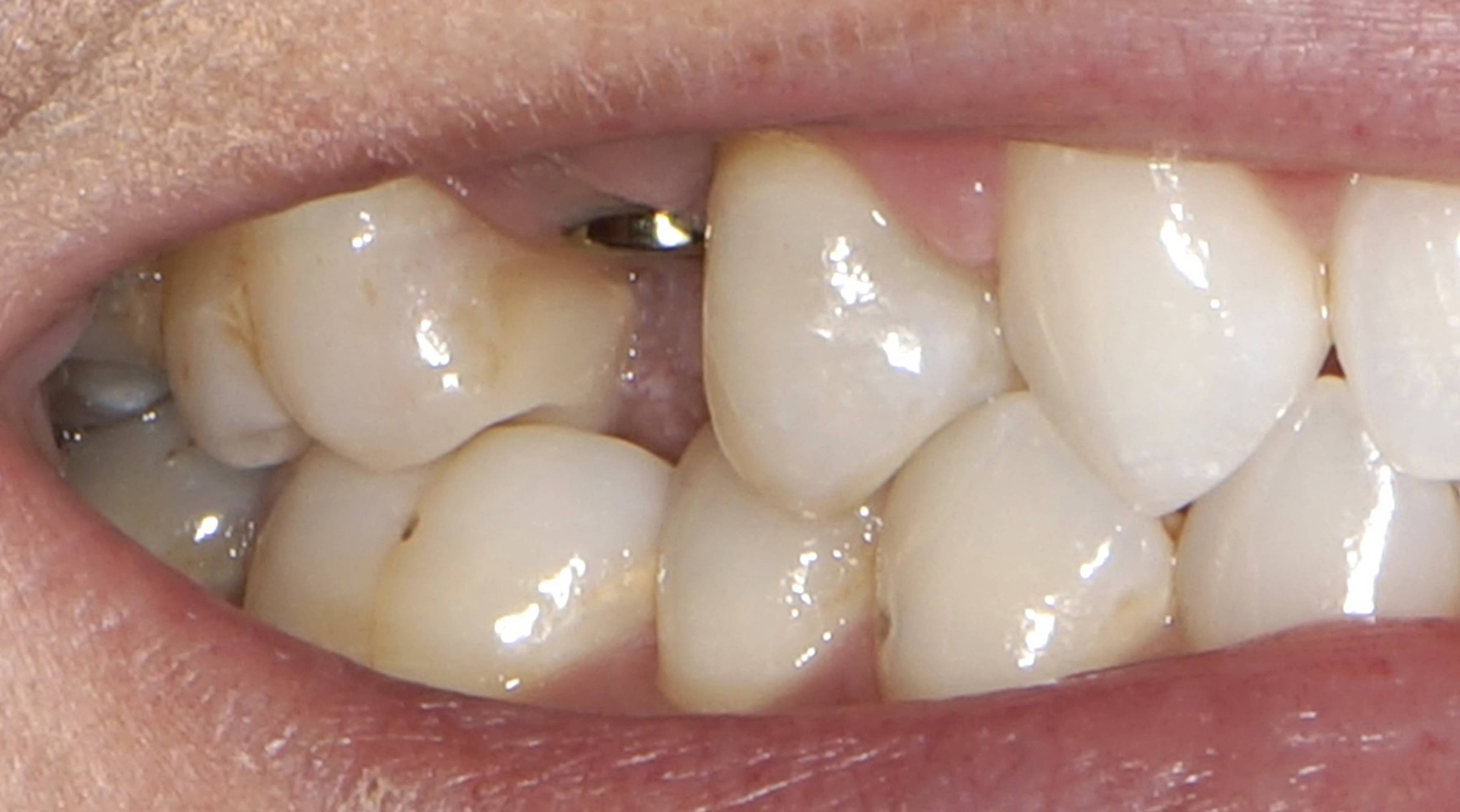 Close-up of a missing tooth gap in the upper jaw before dental implant treatment, highlighting the need for restorative dentistry to restore function and appearance.