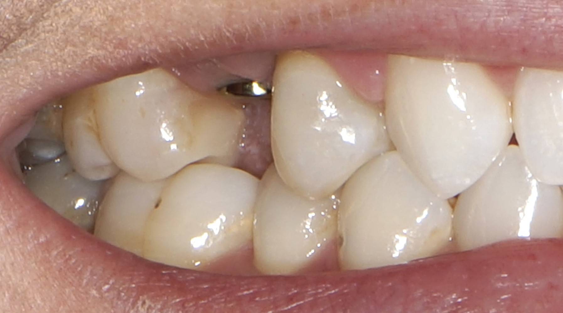 Close-up of a missing tooth gap in the upper jaw before dental implant treatment, highlighting the need for restorative dentistry to restore function and appearance.