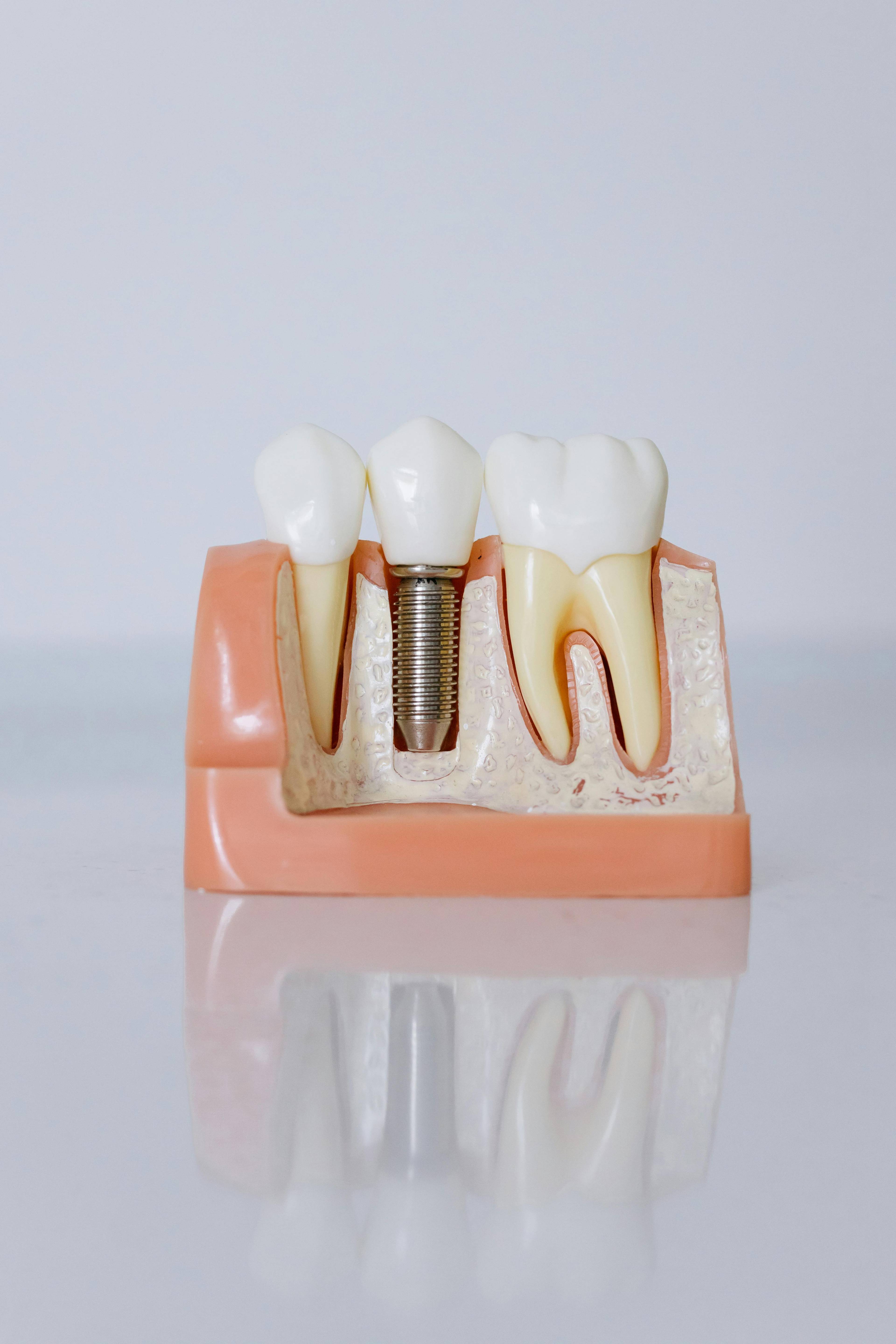 Dental implant model illustrating a single tooth replacement with a titanium implant and dental crown for long-lasting restorative dentistry treatment.
