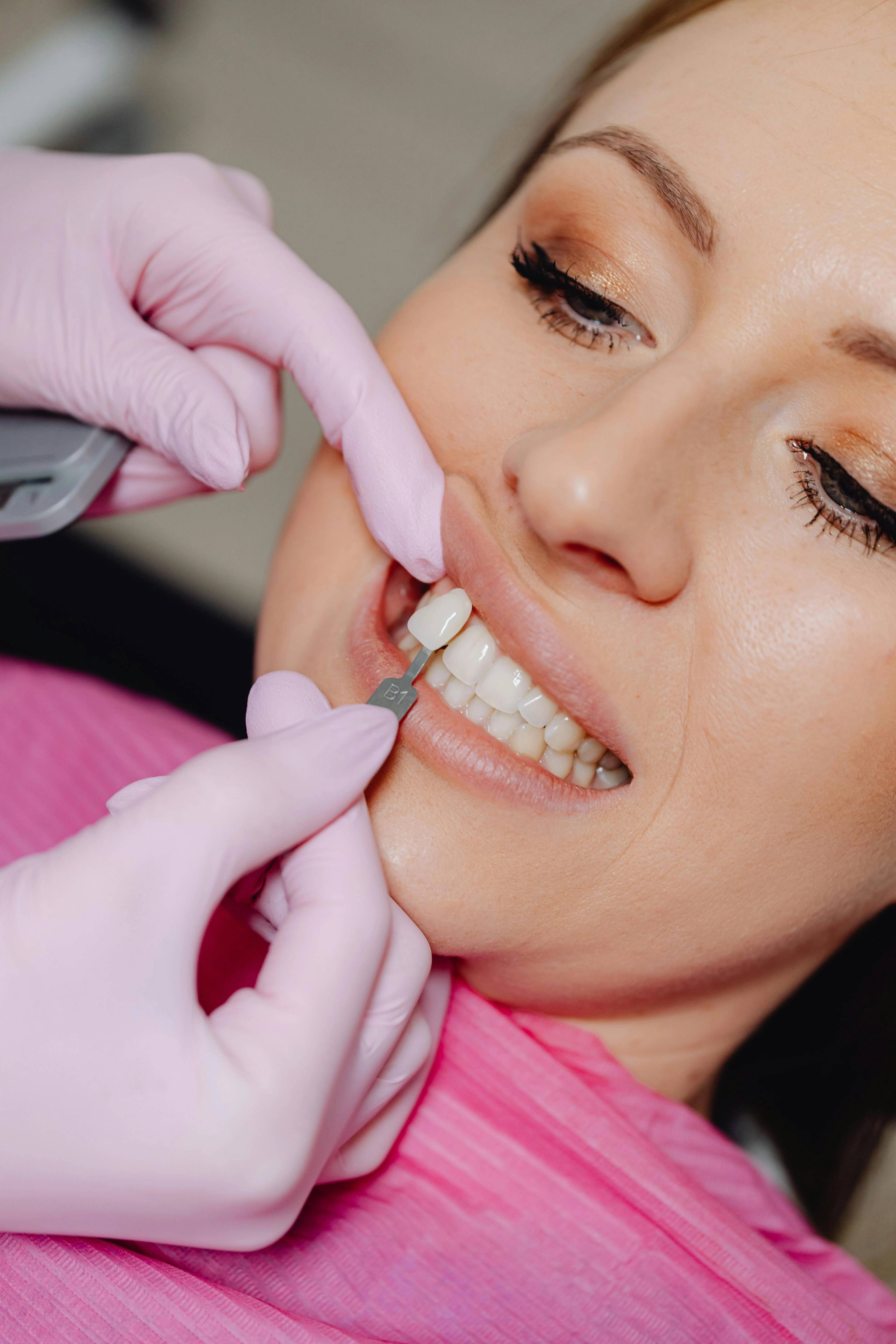 A stock photo of a female veneers patient having a veneer placed onto her tooth by a dentist wearing pink medical examination gloves