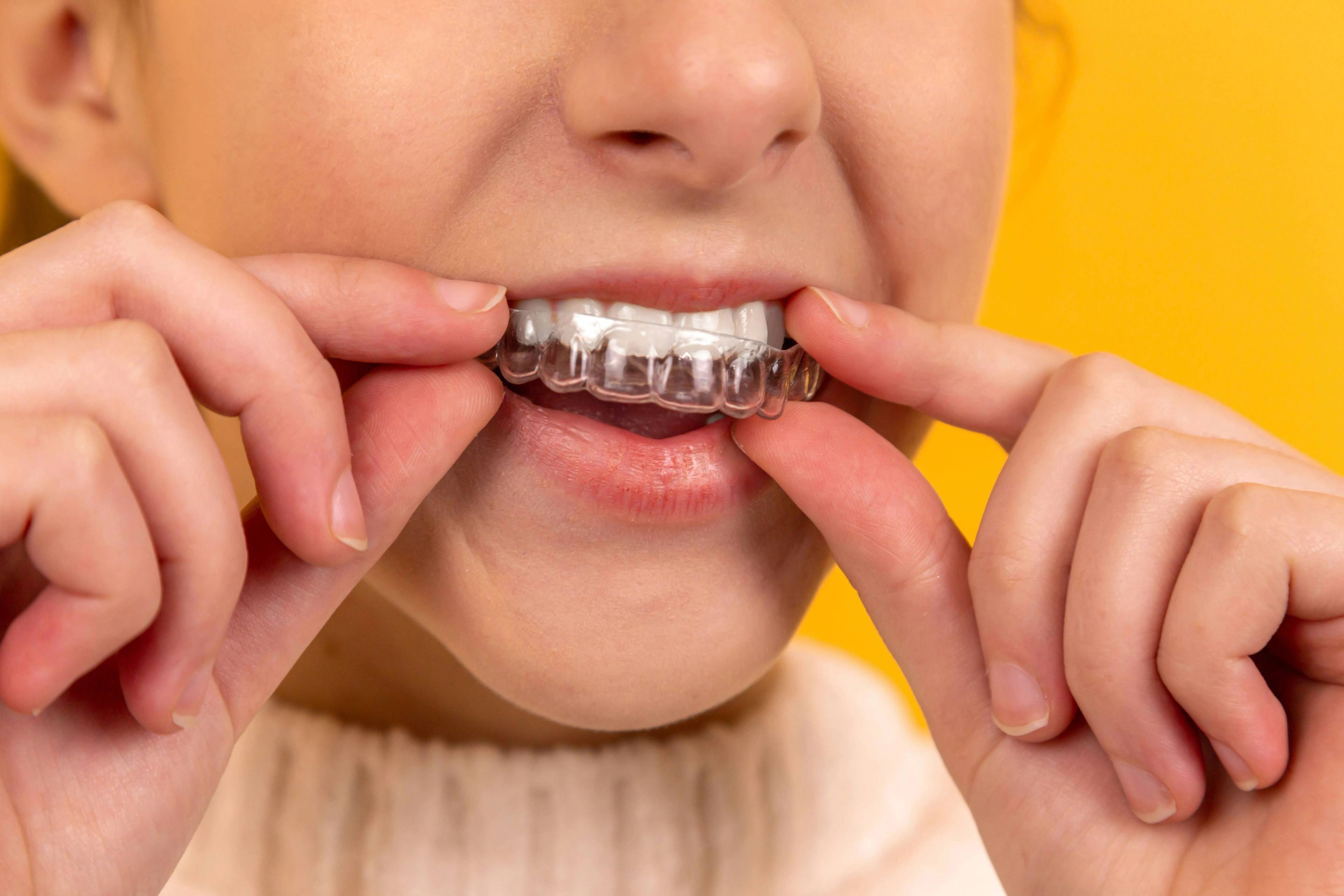 A stock photo of a woman placing a mouth guard over her teeth