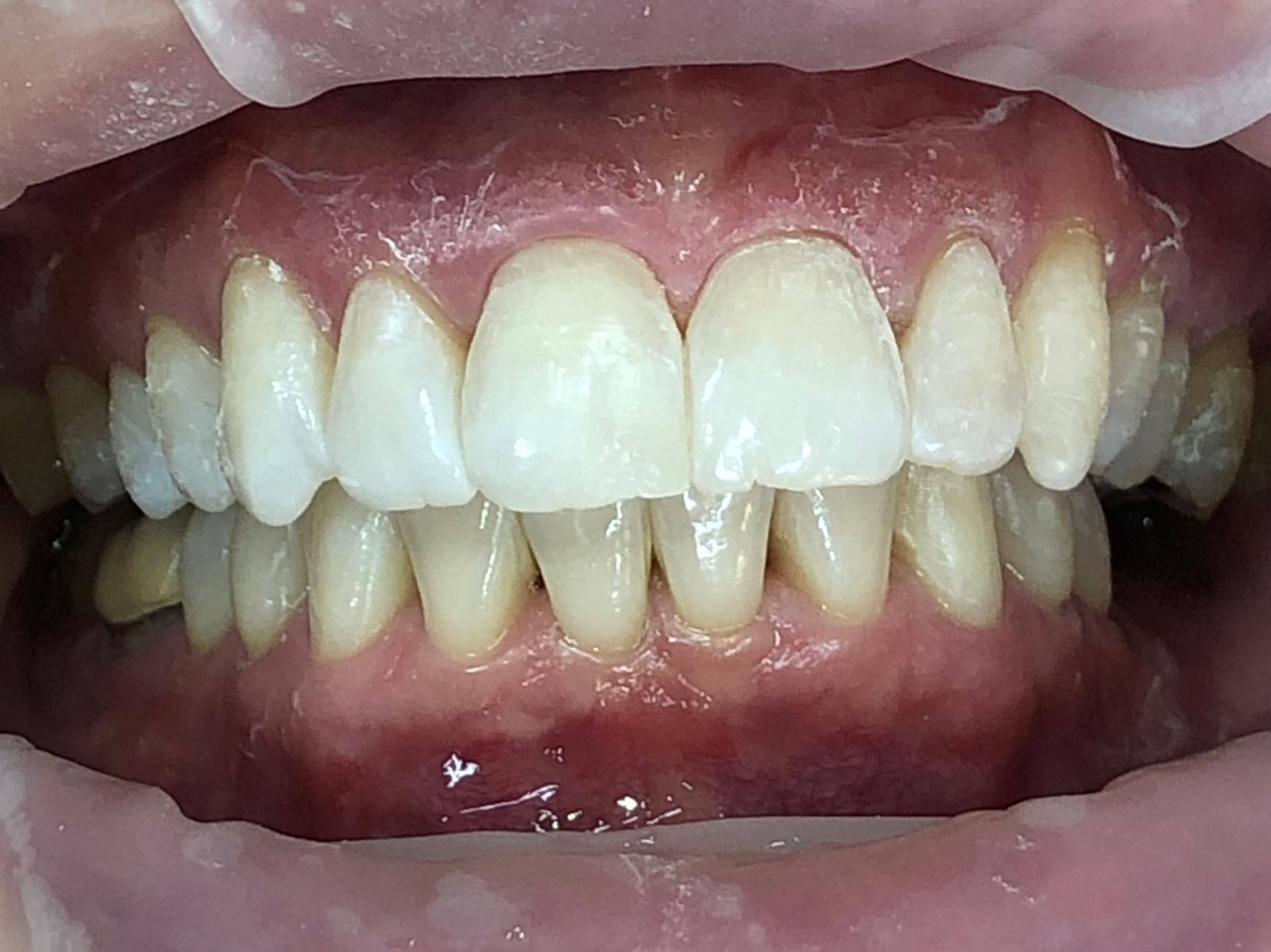 Patient after Invisalign and whitening