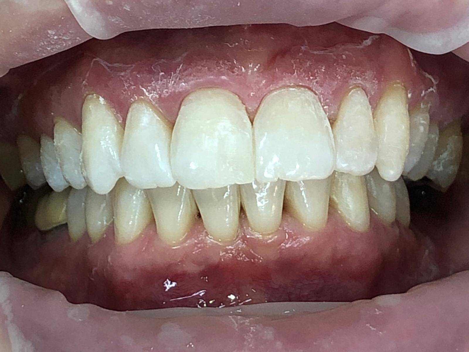 Patient after Invisalign and whitening