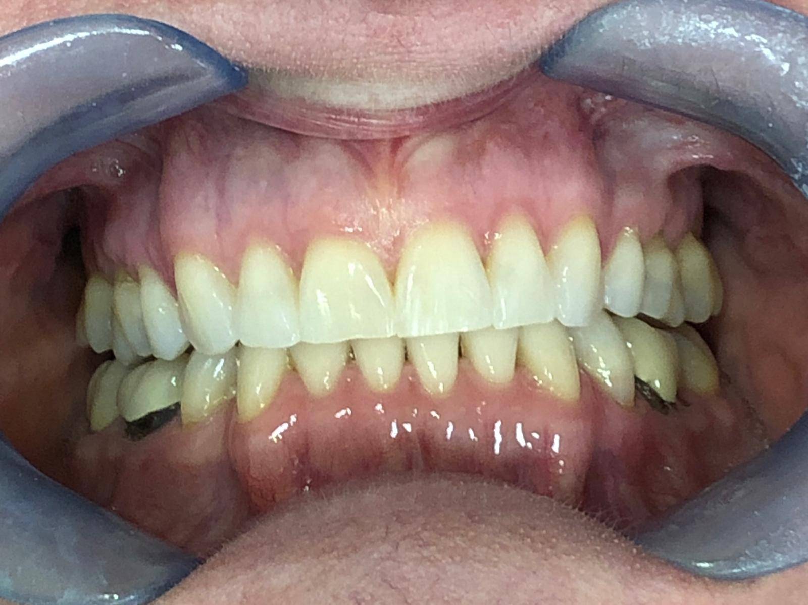 Patient's teeth after Invisalign