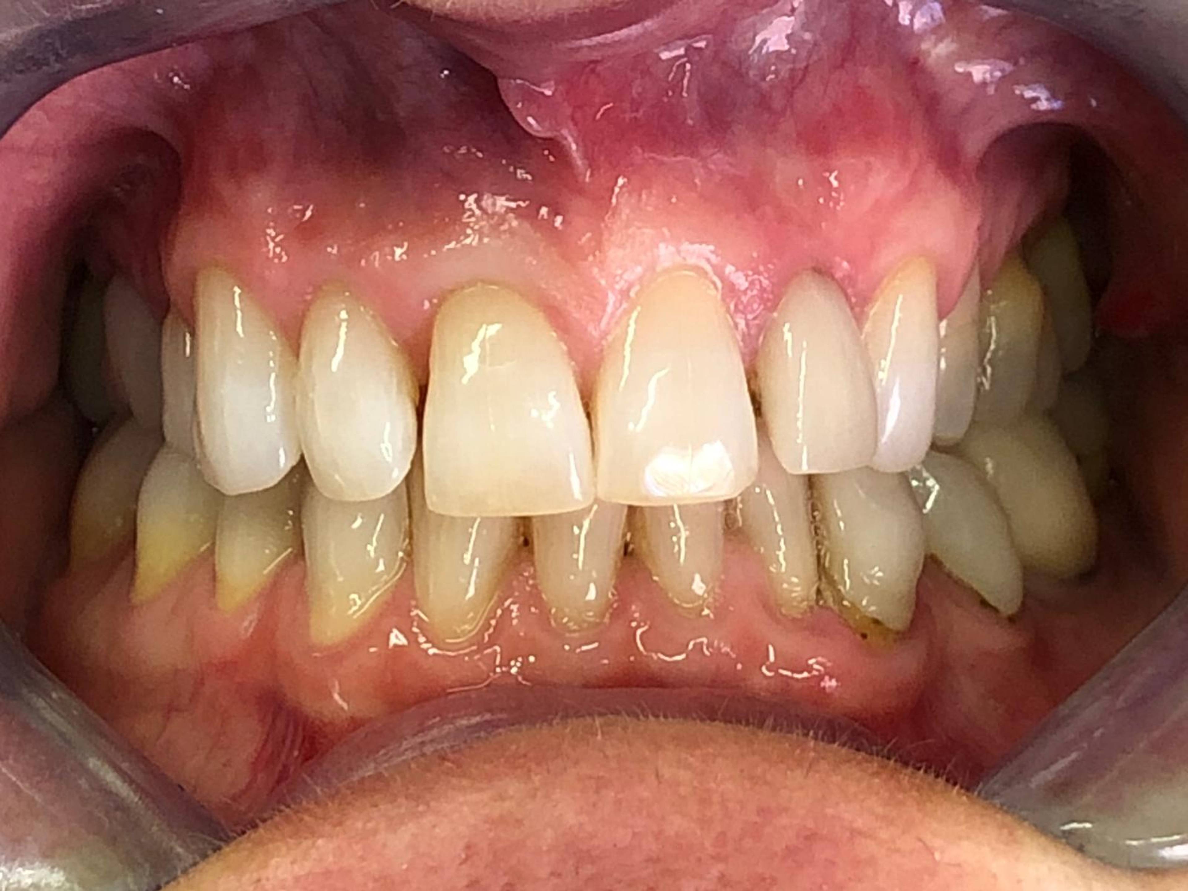 Patient before Invisalign treatment
