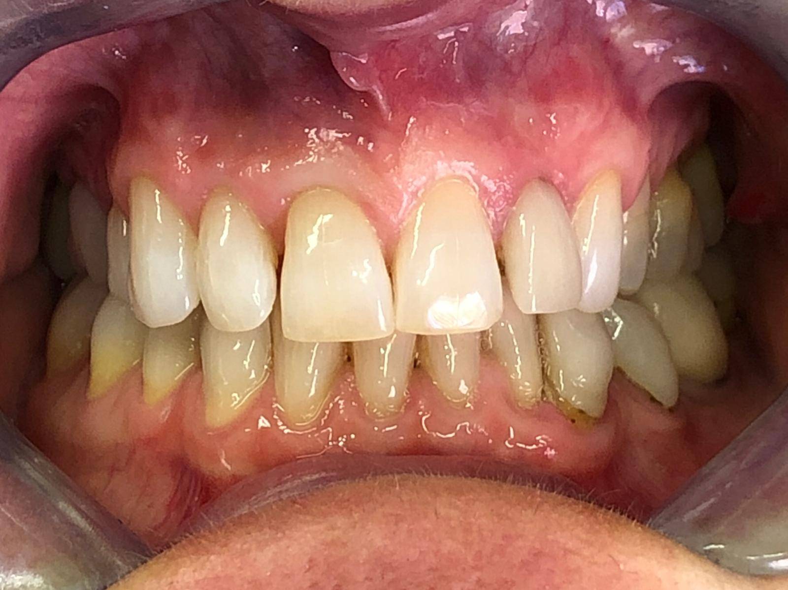 Patient before Invisalign treatment