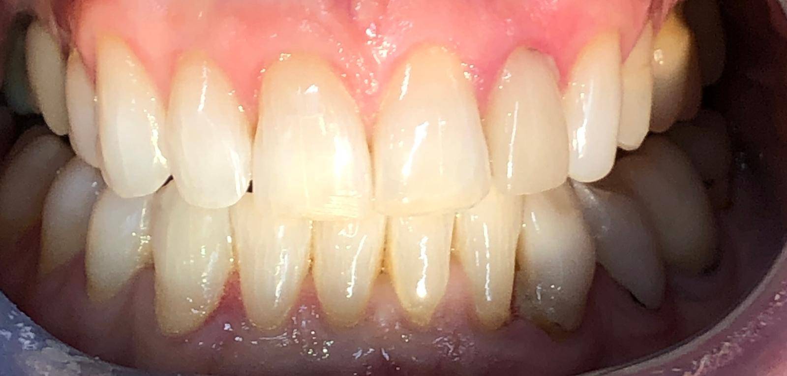 Patient after Invisalign treatment