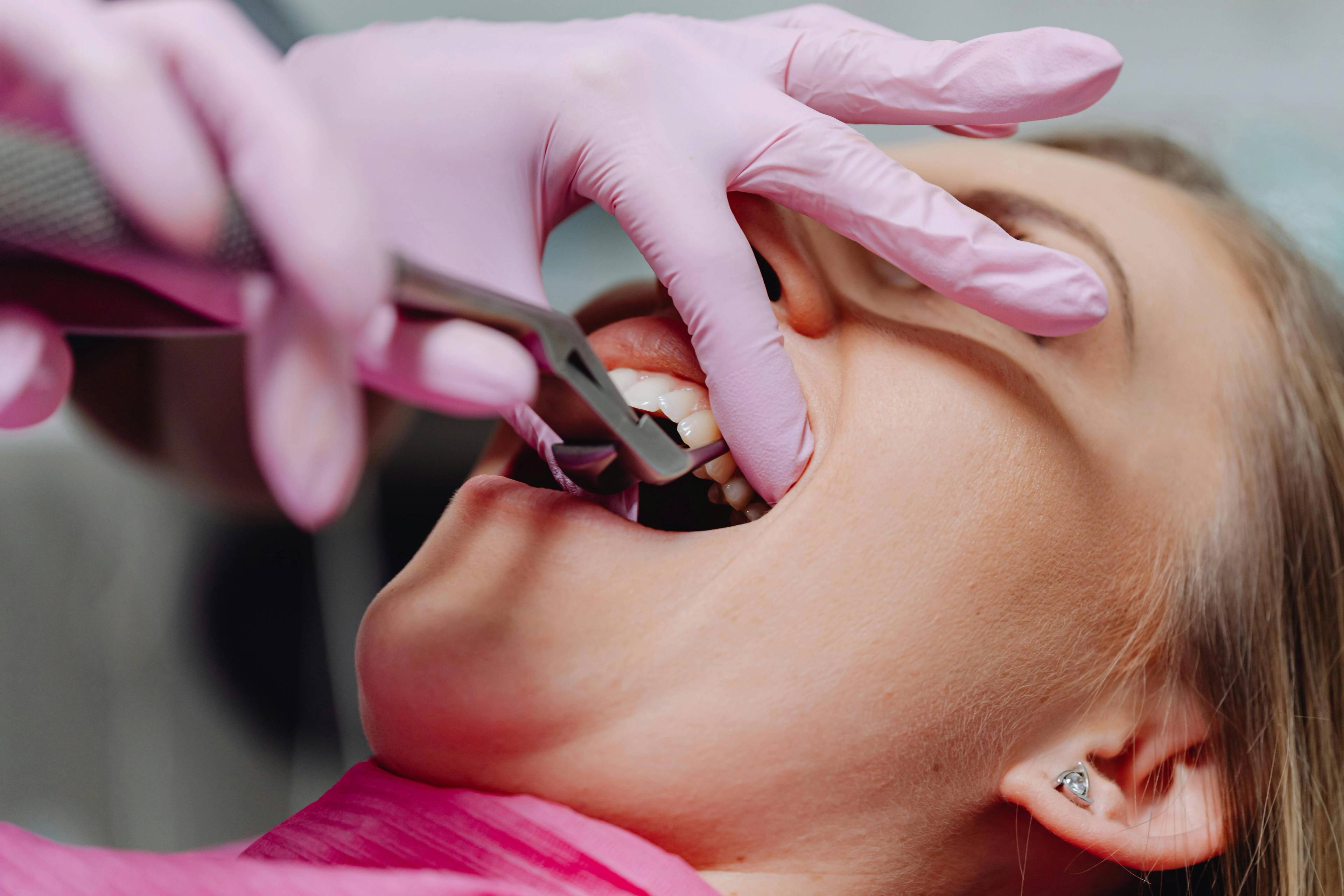 A stock photo of a patient having a tooth removed by a dentist wearing pink medical gloves