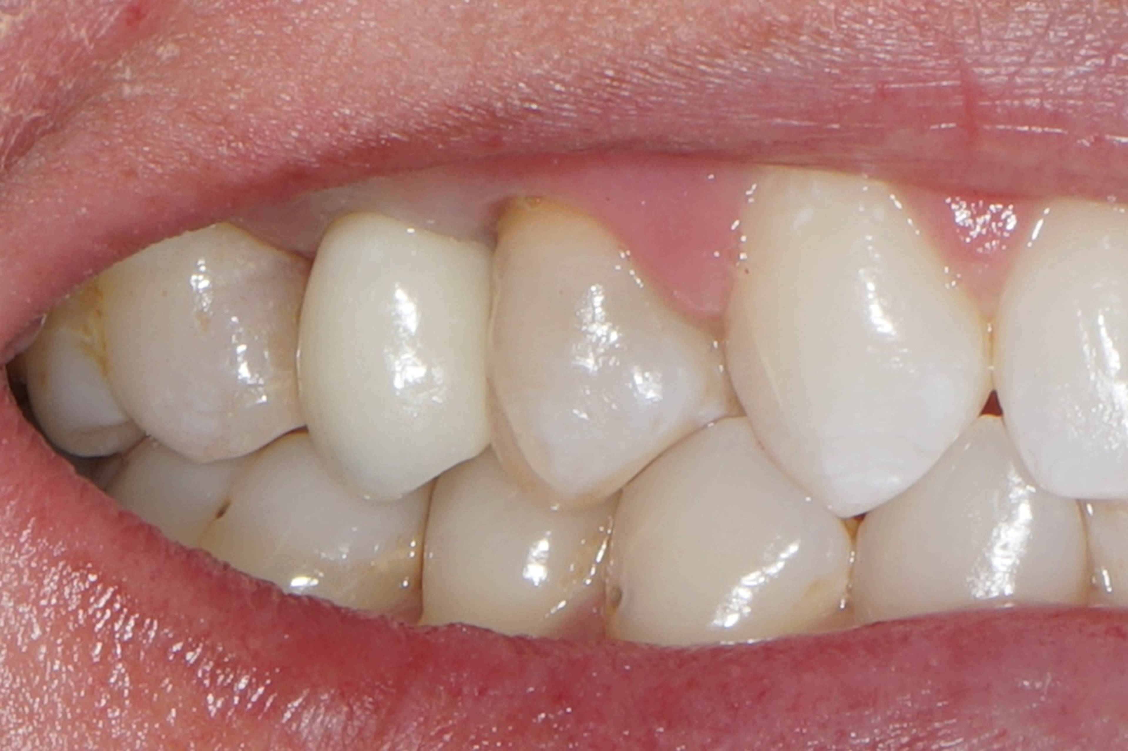 Close-up view of a completed dental bridge replacing a missing tooth, restoring a natural-looking smile with durable restorative dentistry treatment.