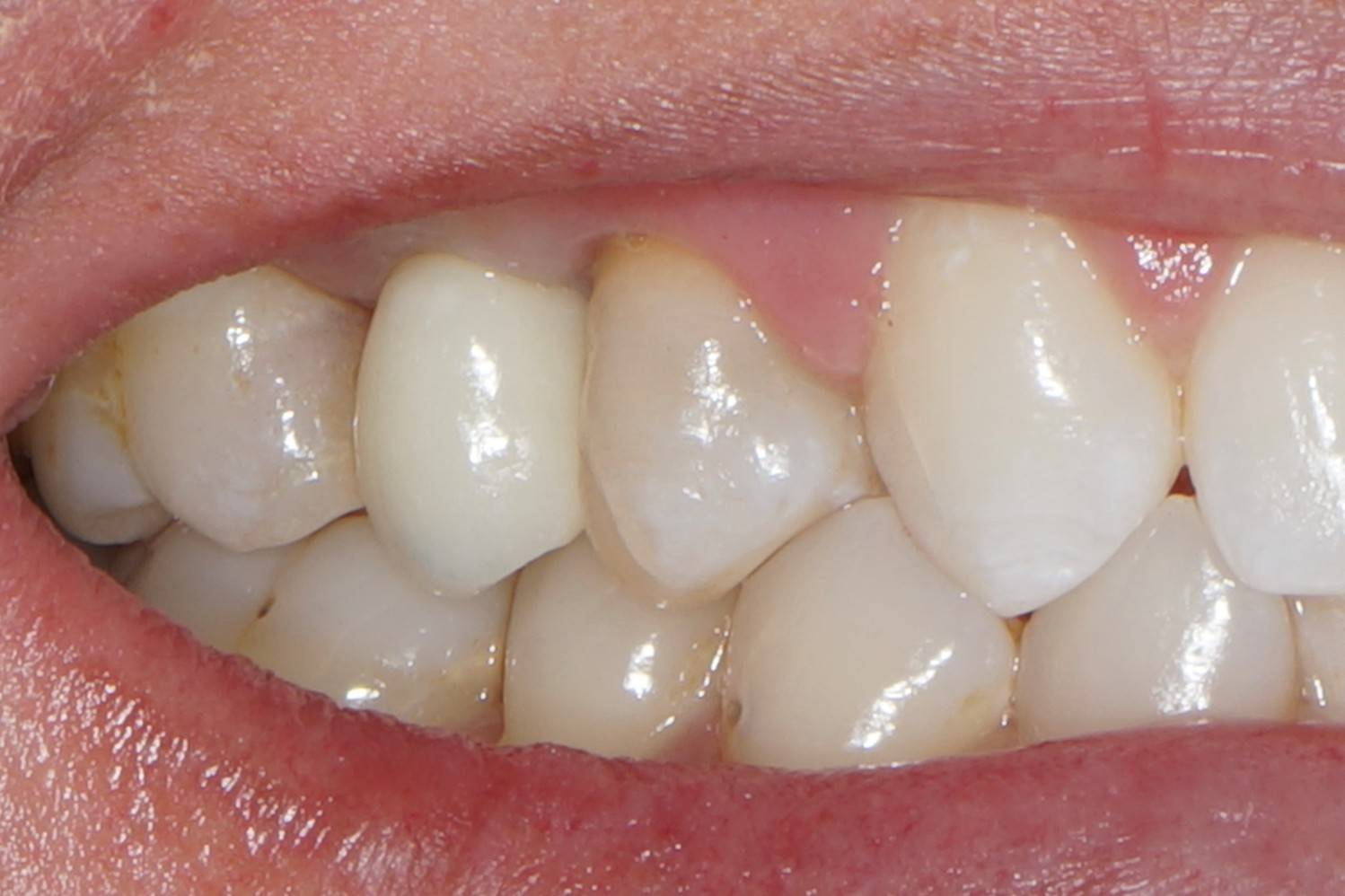 Close-up view of a completed dental bridge replacing a missing tooth, restoring a natural-looking smile with durable restorative dentistry treatment.