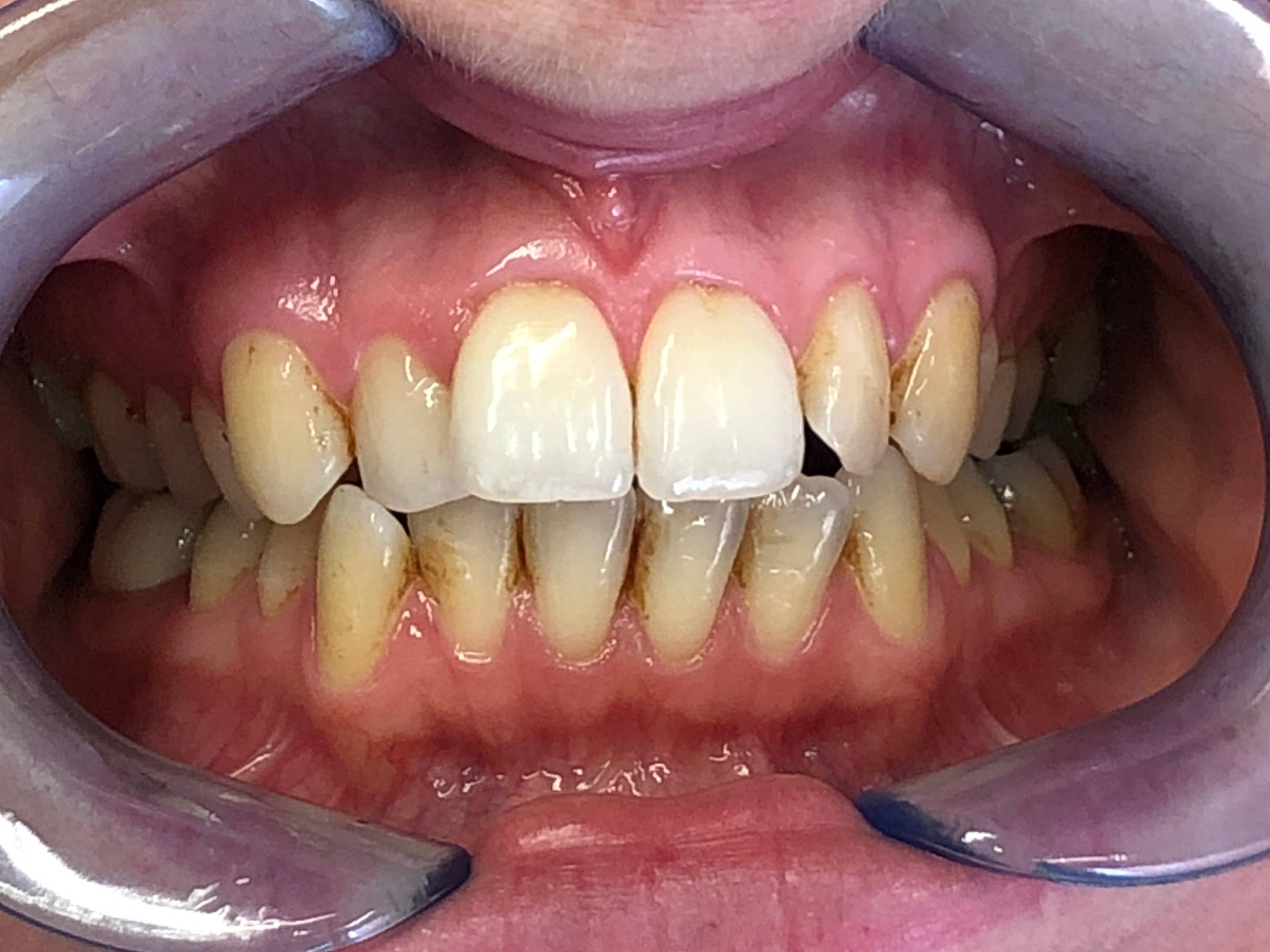 Patient's teeth before Invisalign and whitening