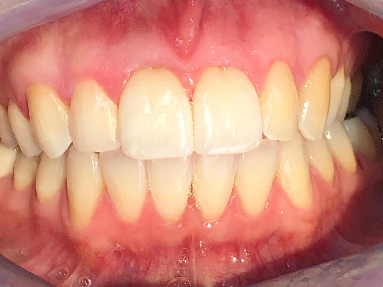 Patient's teeth after Invisalign and whitening