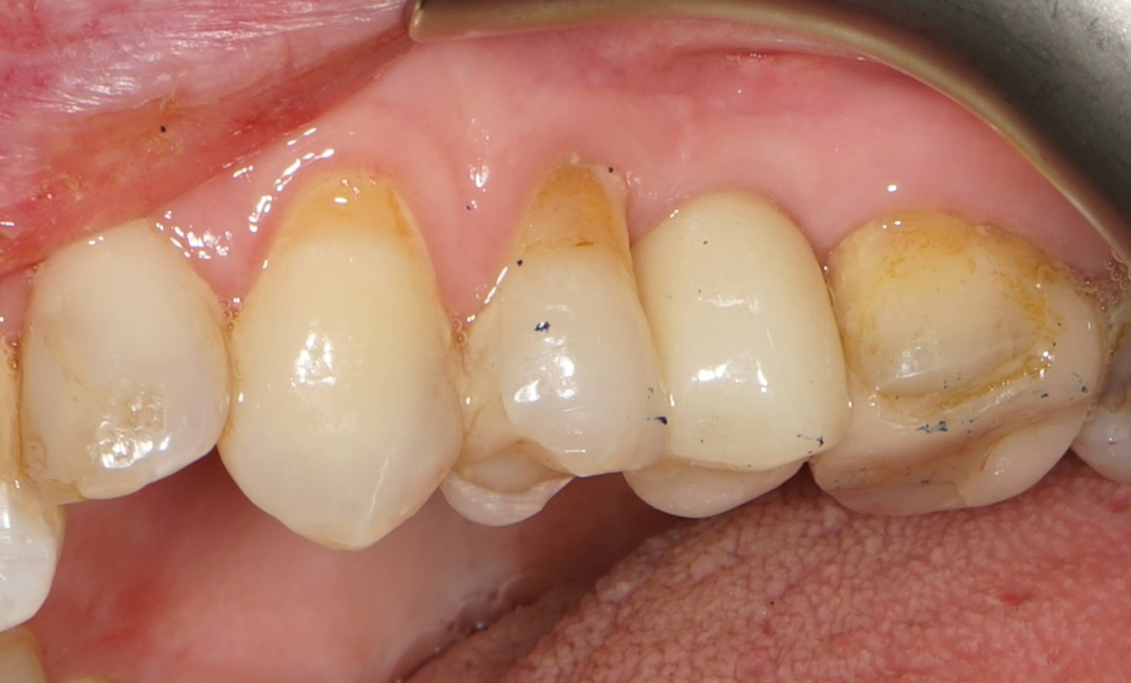 Completed dental bridge restoration replacing a missing tooth, providing a natural-looking smile and improved chewing function through restorative dentistry treatment.