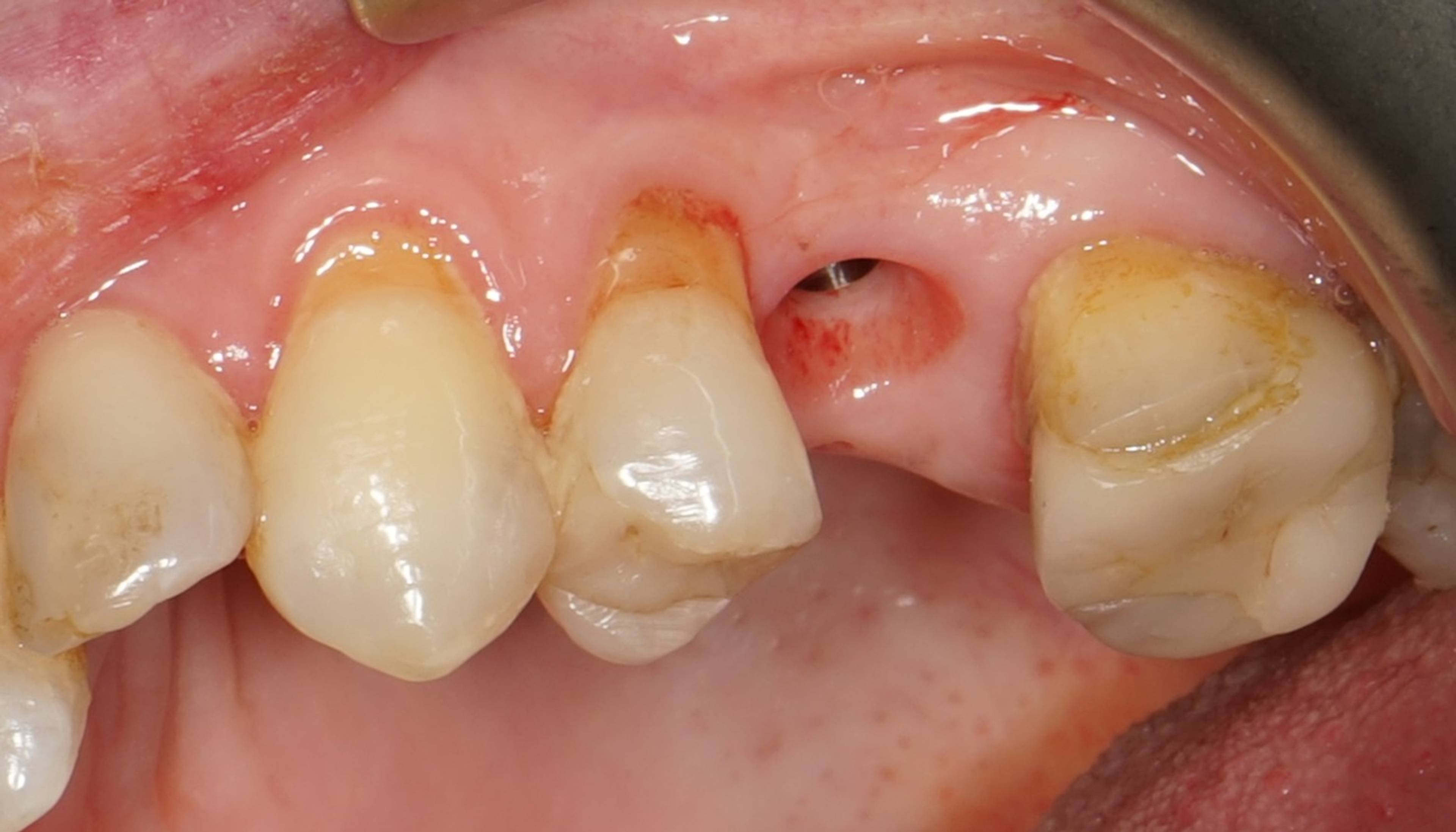 Close-up of a missing tooth site prepared for dental implant treatment, showing the implant access opening and surrounding gum tissue before final restorative dentistry placement.
