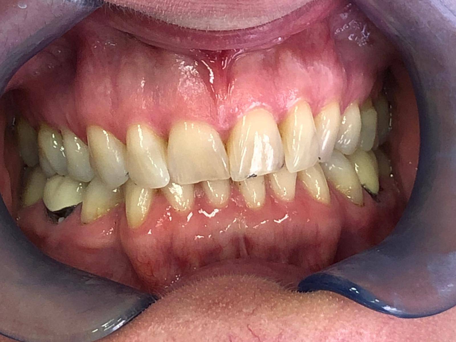 Patient's teeth before Invisalign