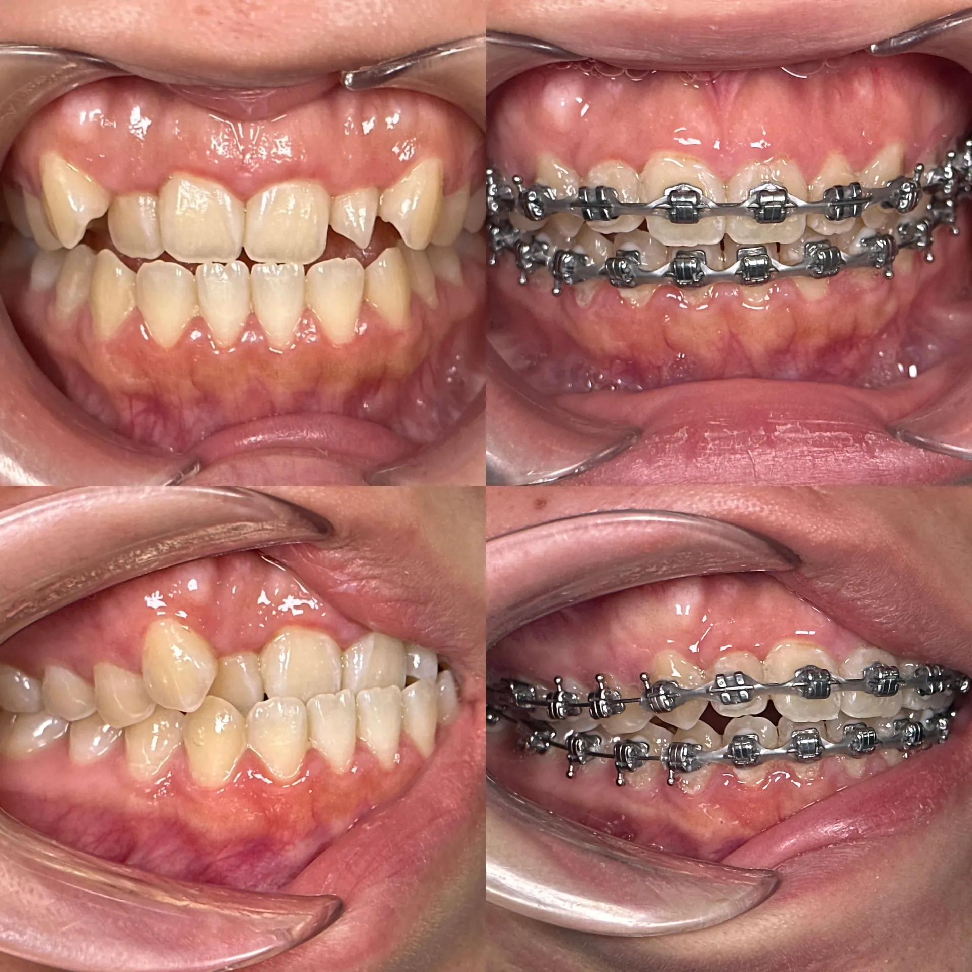 Smile transformation 3