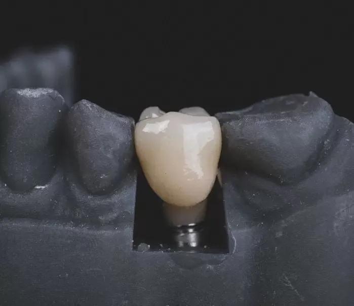 Single Dental Implants