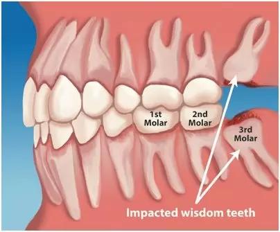 Wisdom Teeth Removal