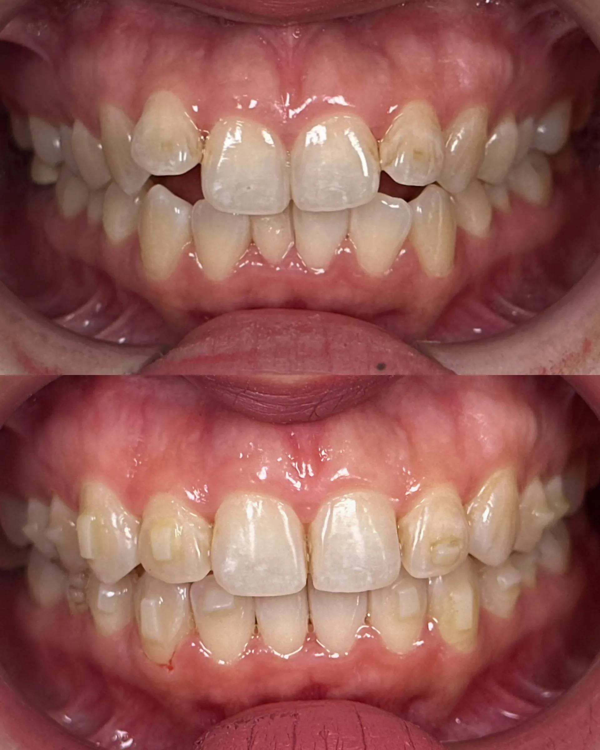 Smile Transformation — Dr Dylan Dental