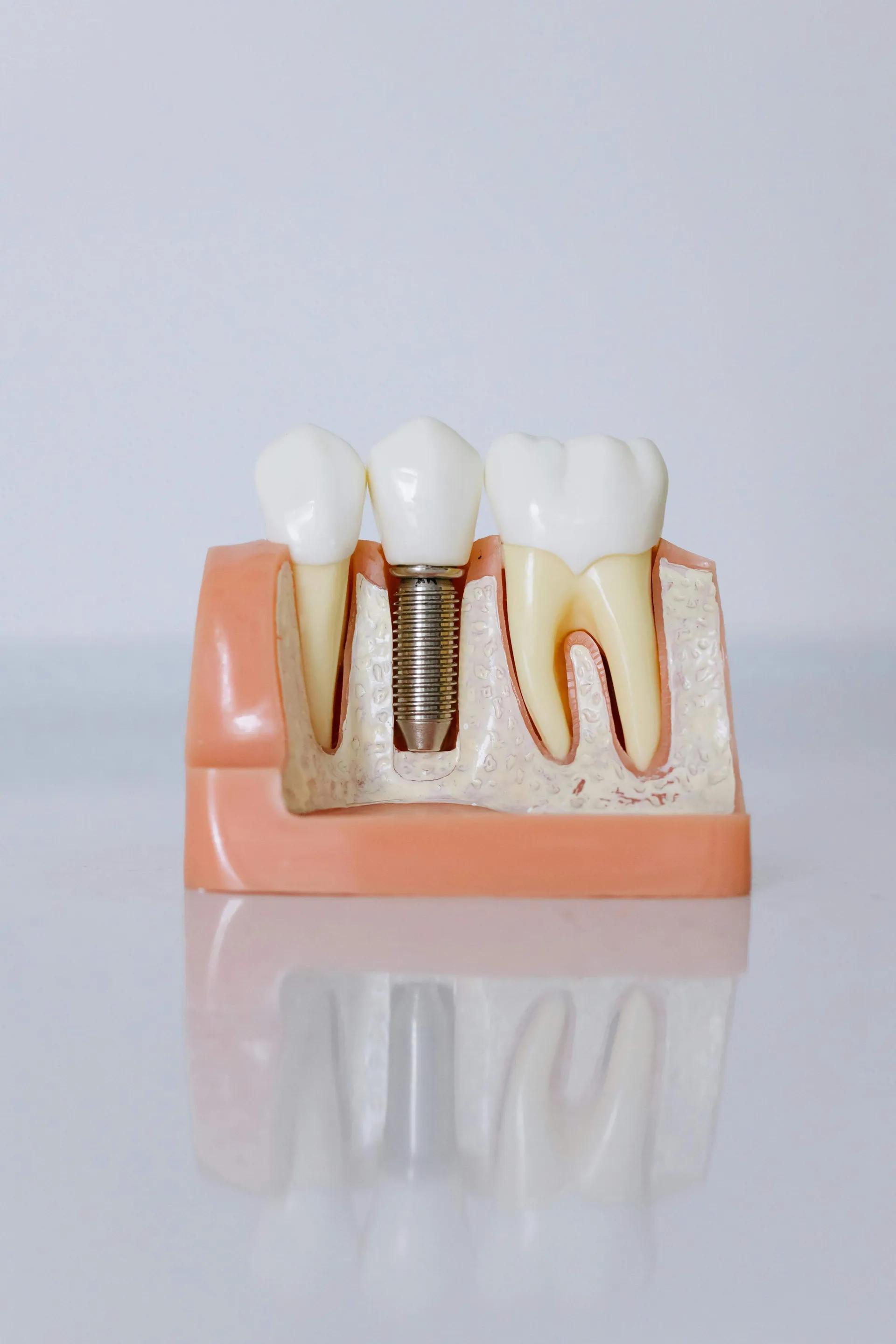 Dental Bridges