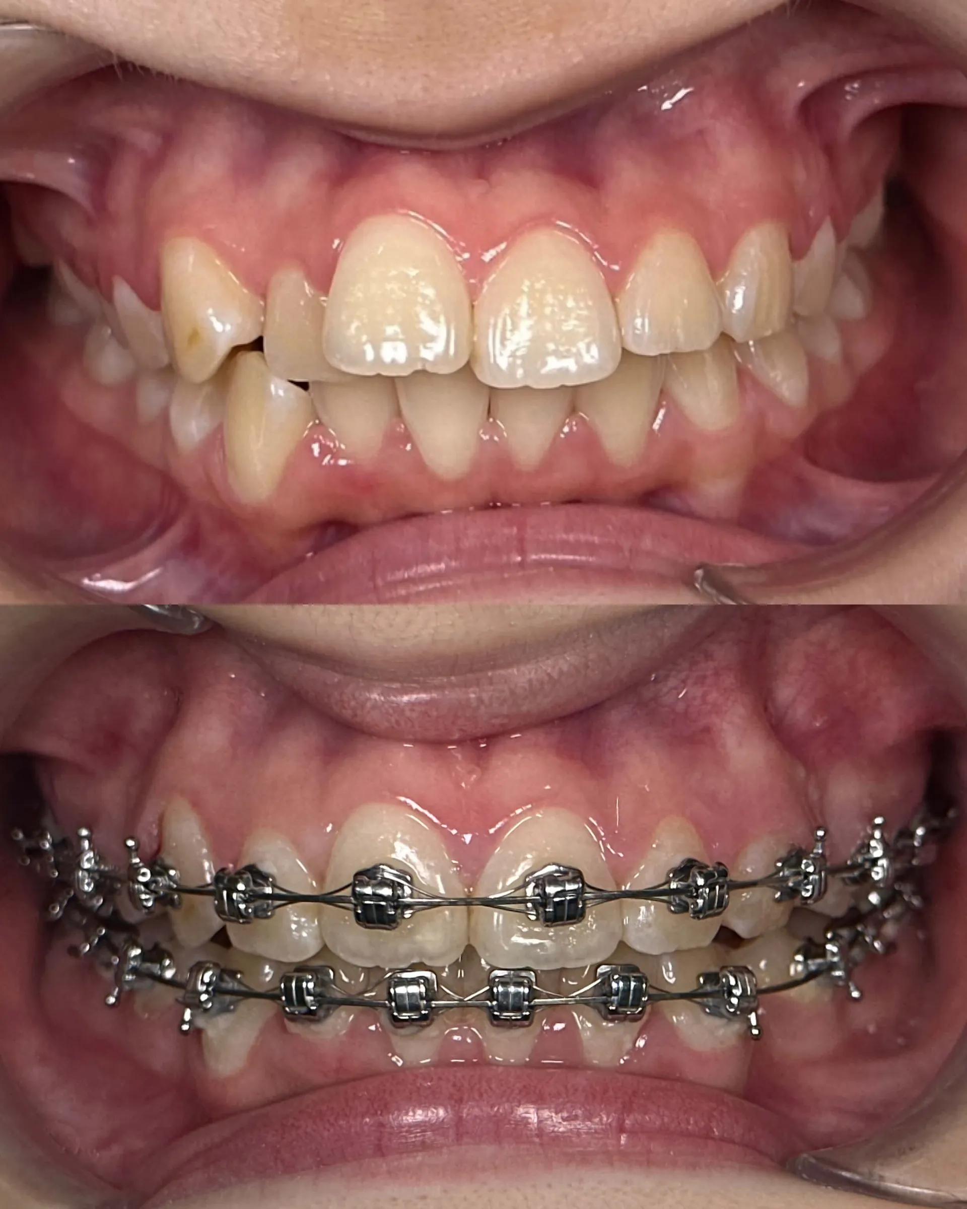 Smile Transformation Result 4