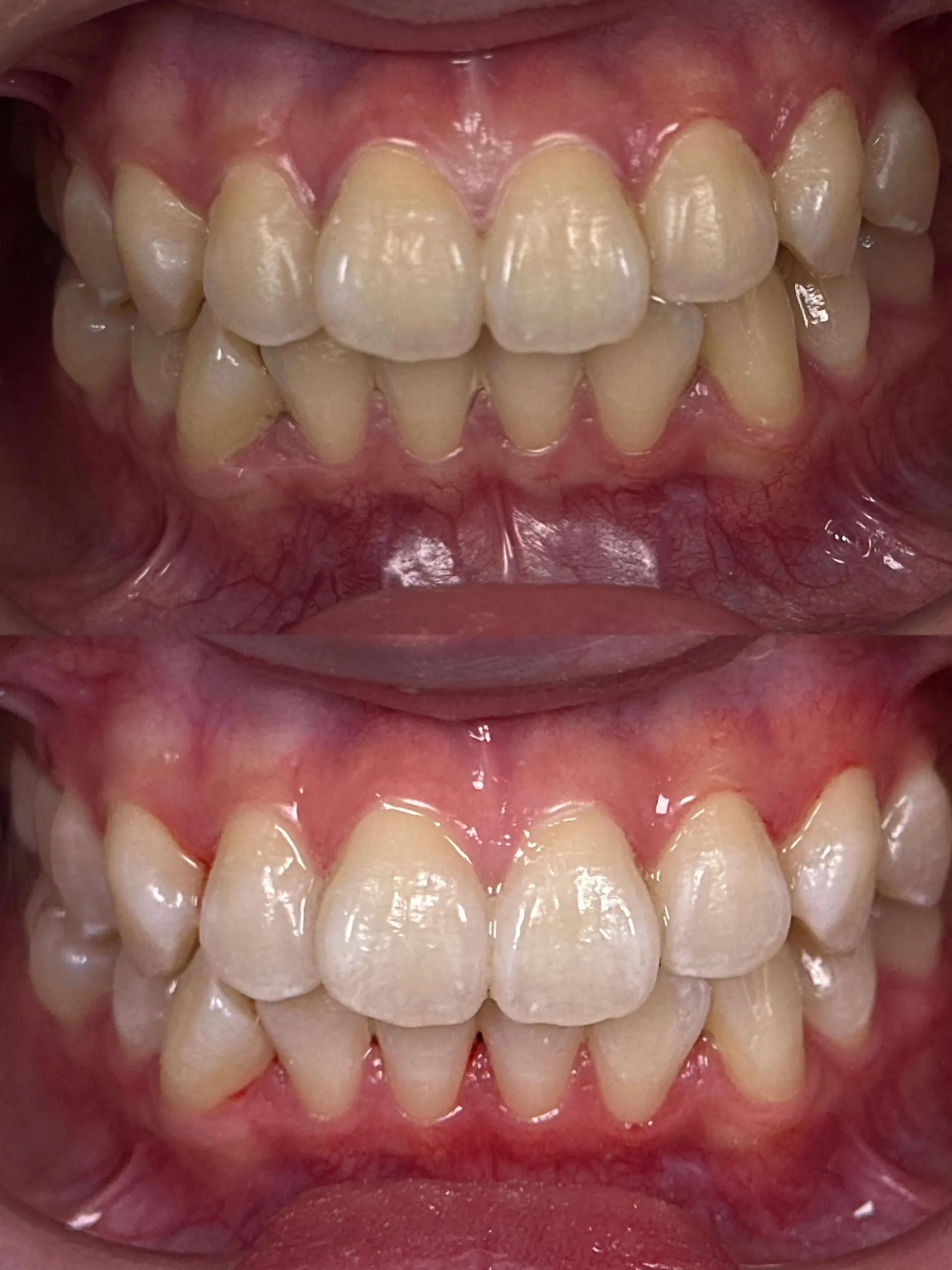 Smile Transformation Result 5