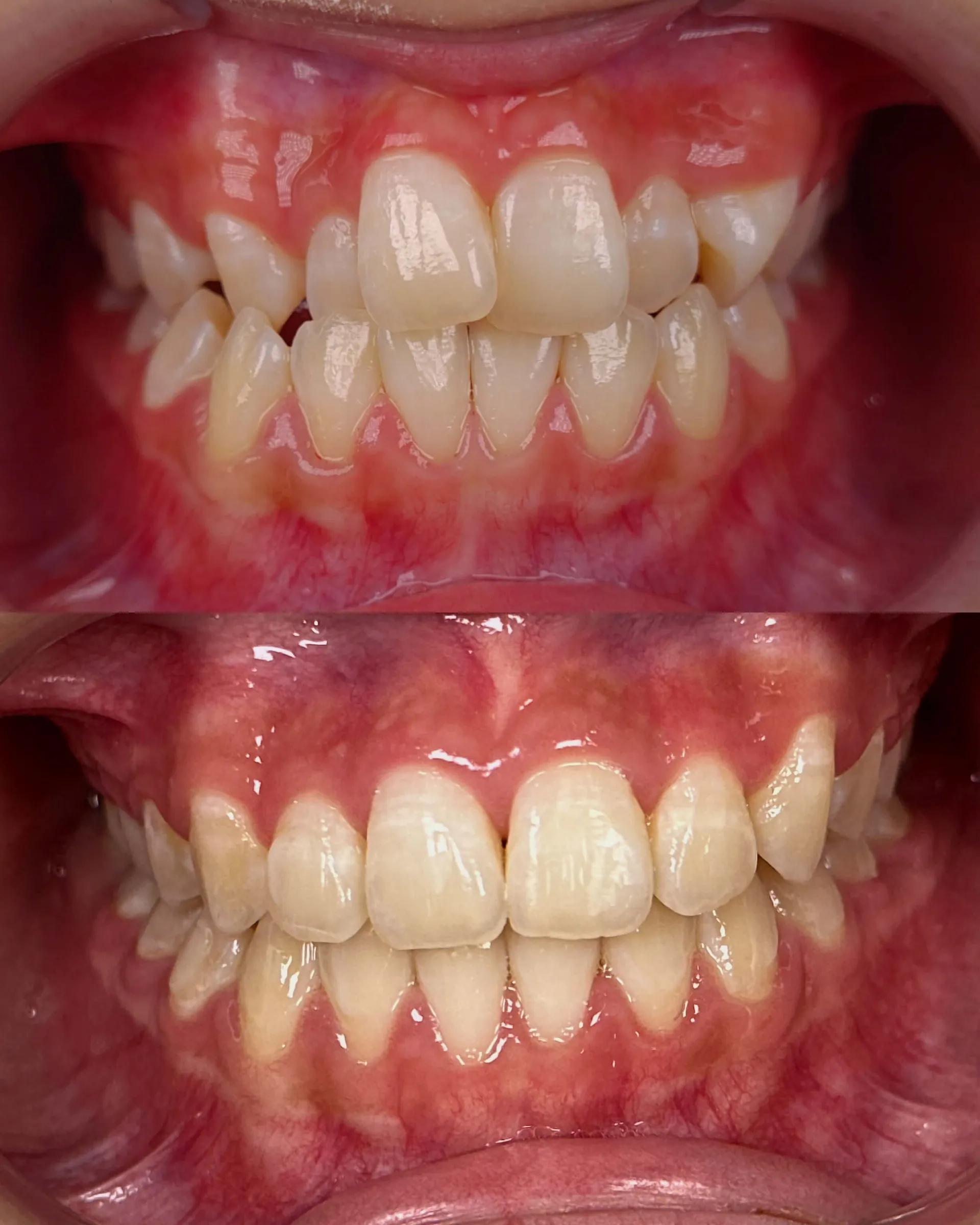 Smile Transformation Result 6