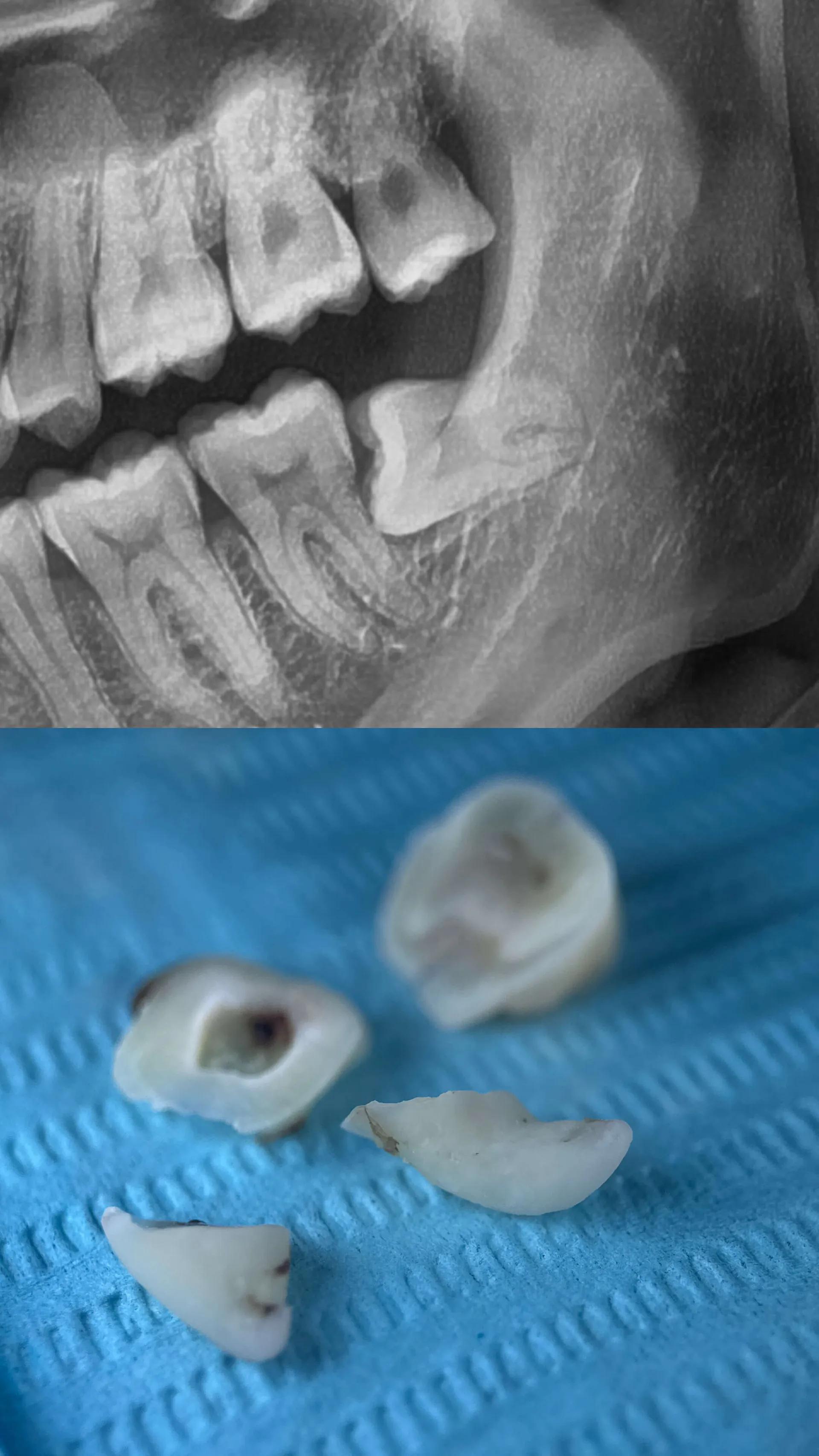 Wisdom Teeth Surgery