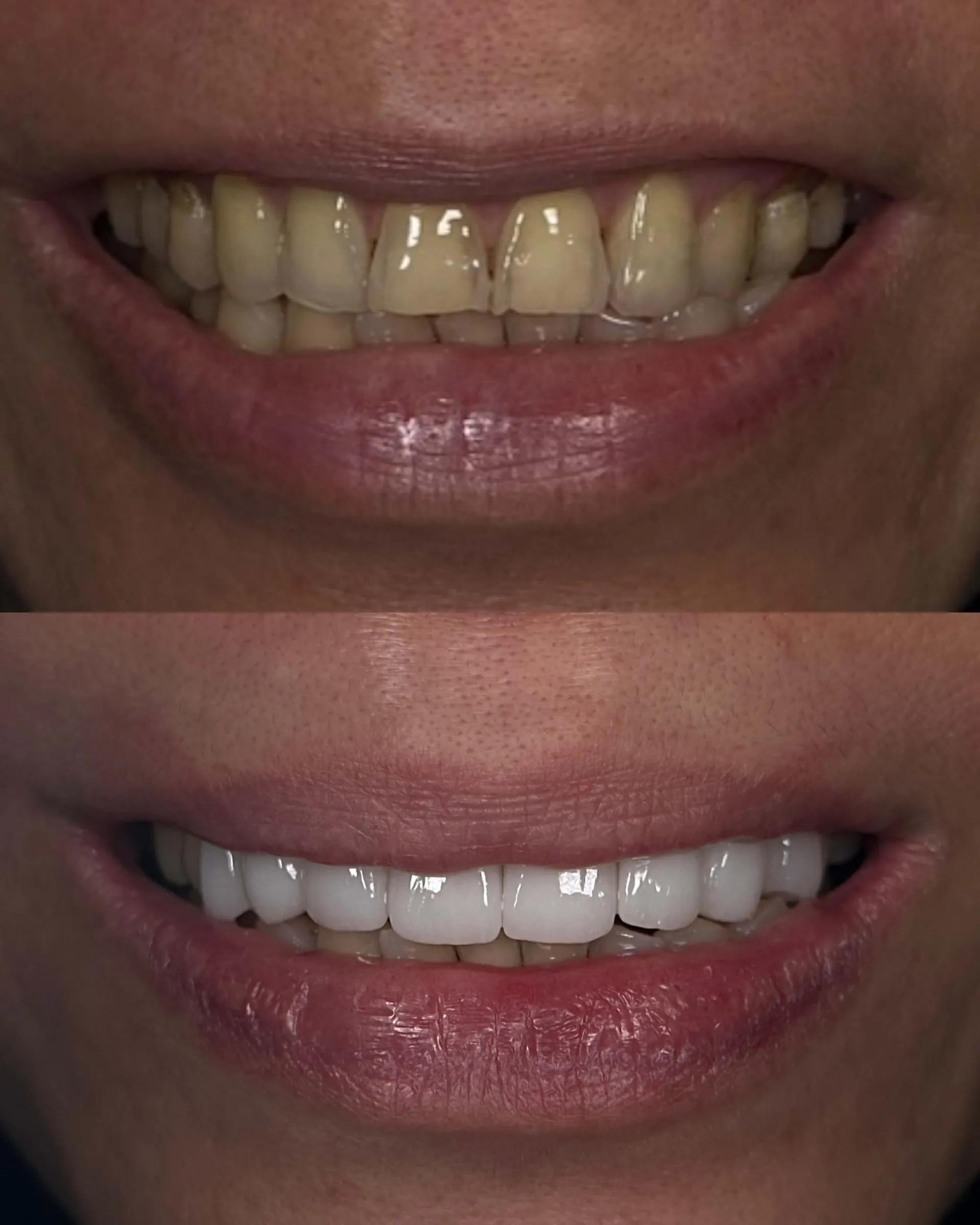 Smile Transformation Result 2