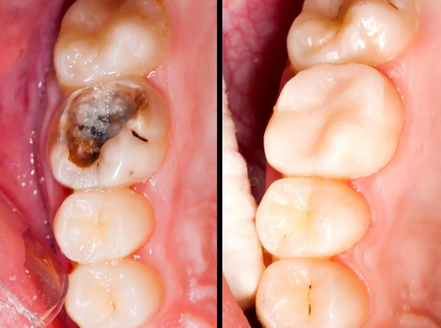 Dental Fillings