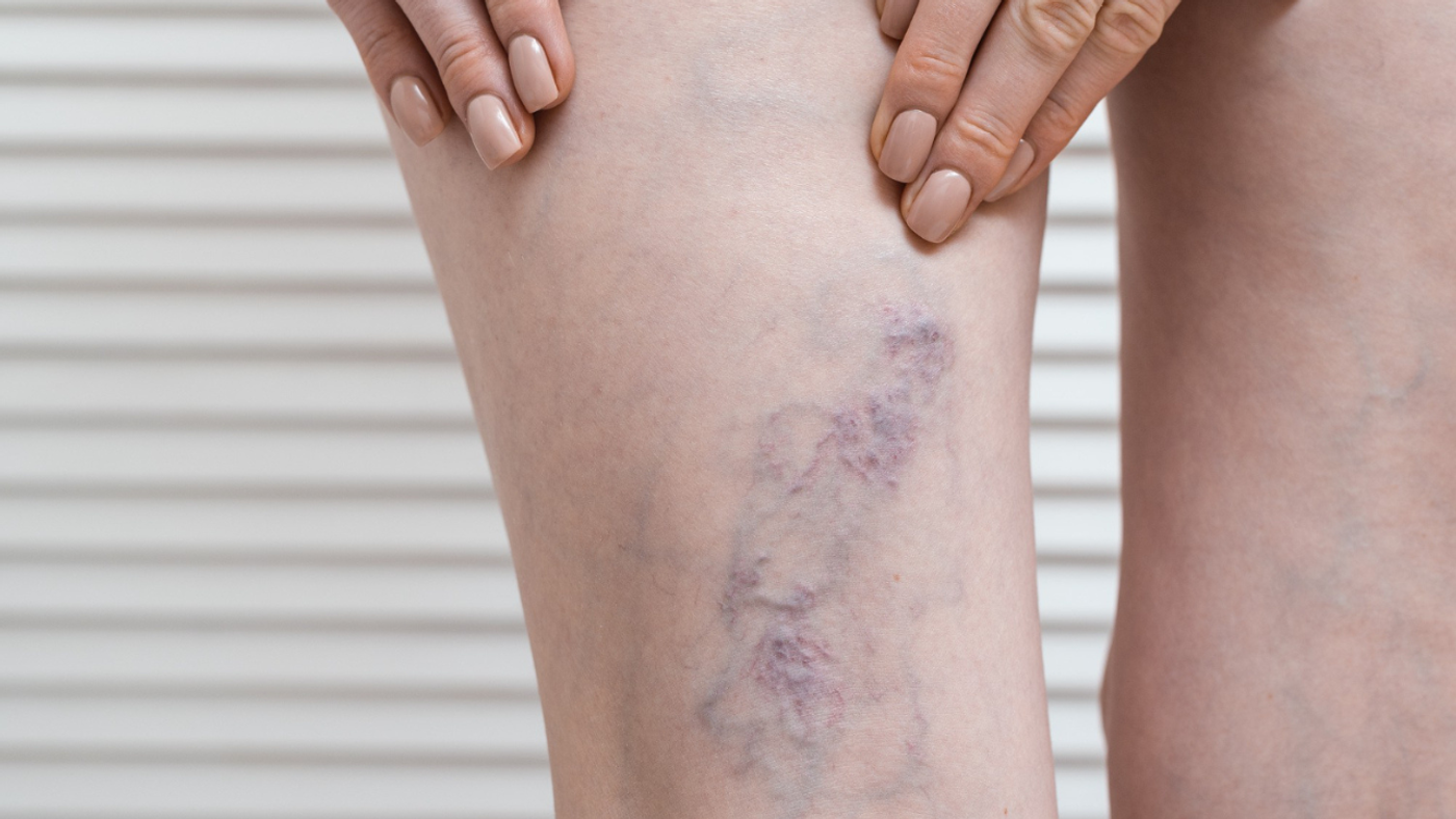 ¿Se pueden tratar las várices si tomo anticoagulantes?