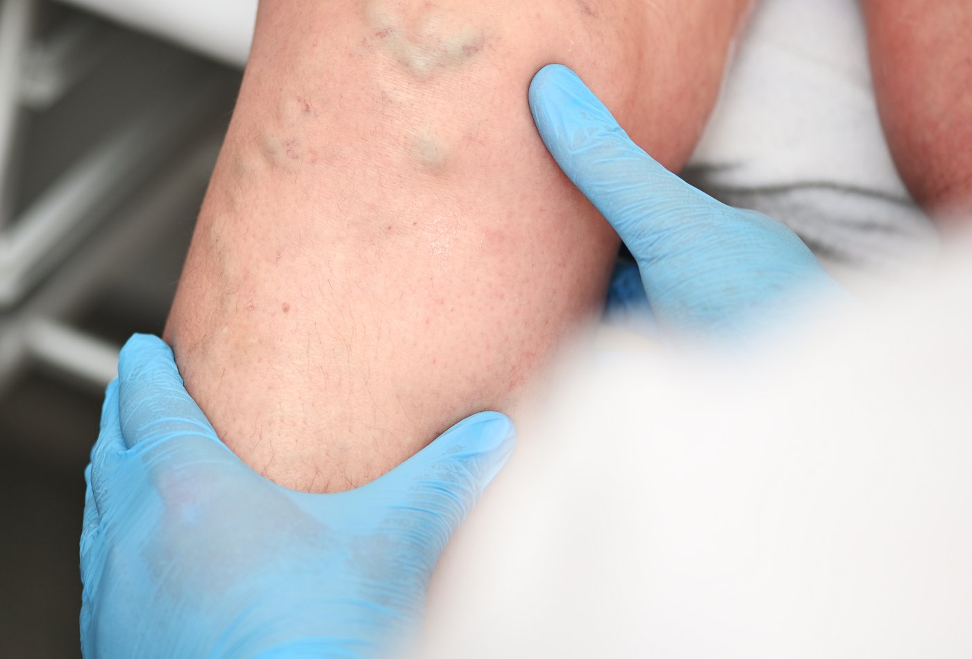 Exploración de las piernas para valorar várices y salud de la piel