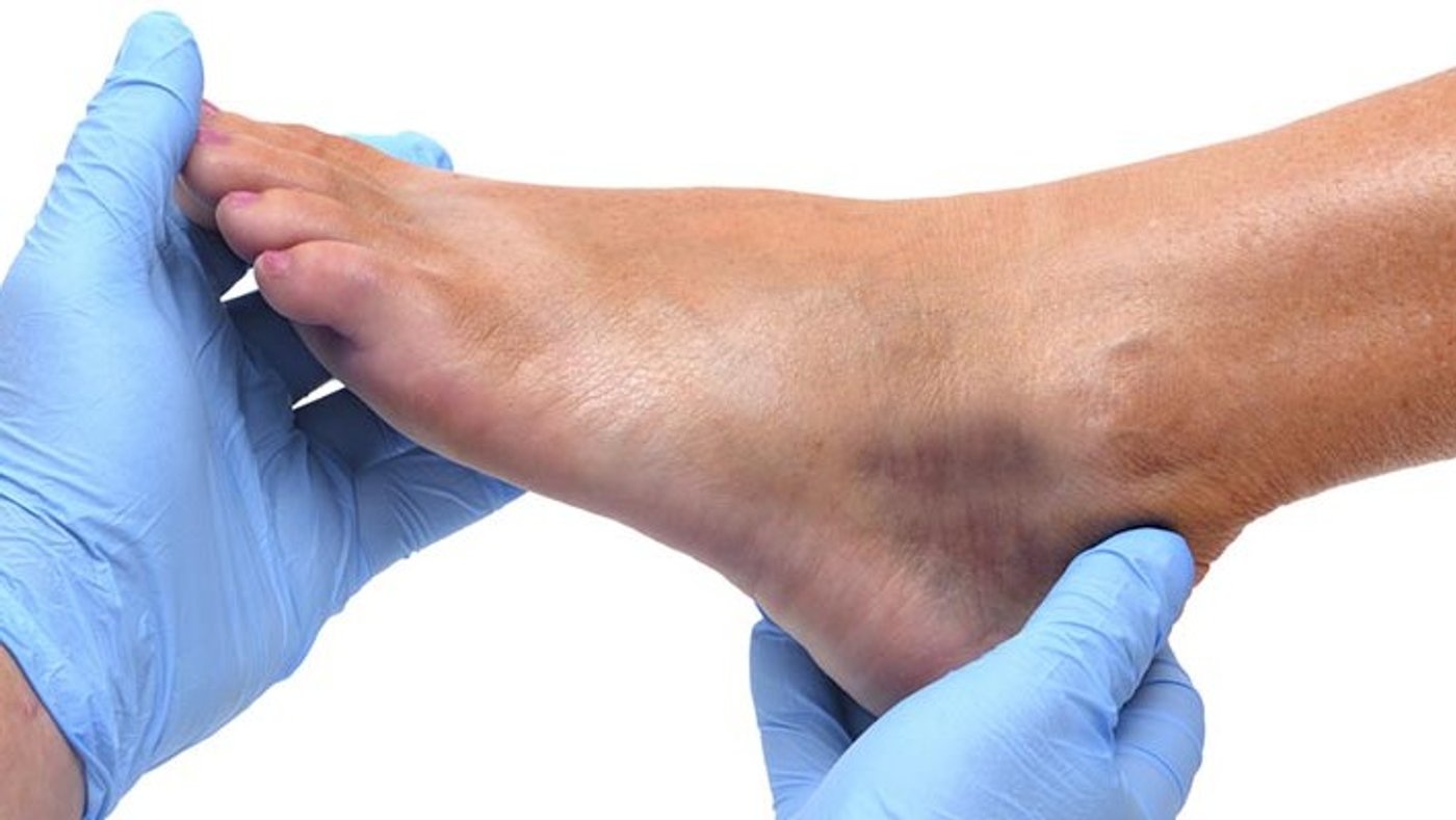 Úlceras venosas: por qué aparecen en las piernas y cómo se tratan