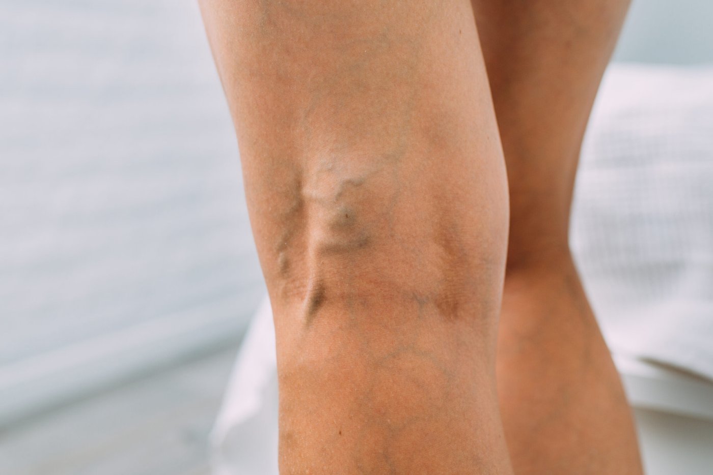 ¿Qué cuidados debo tener después de la escleroterapia?