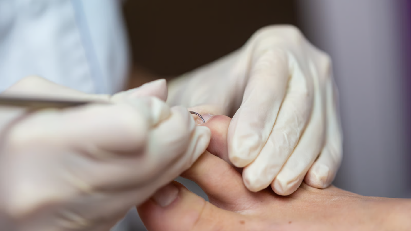 Cómo cortar las uñas si tienes diabetes (sin terminar en el hospital)