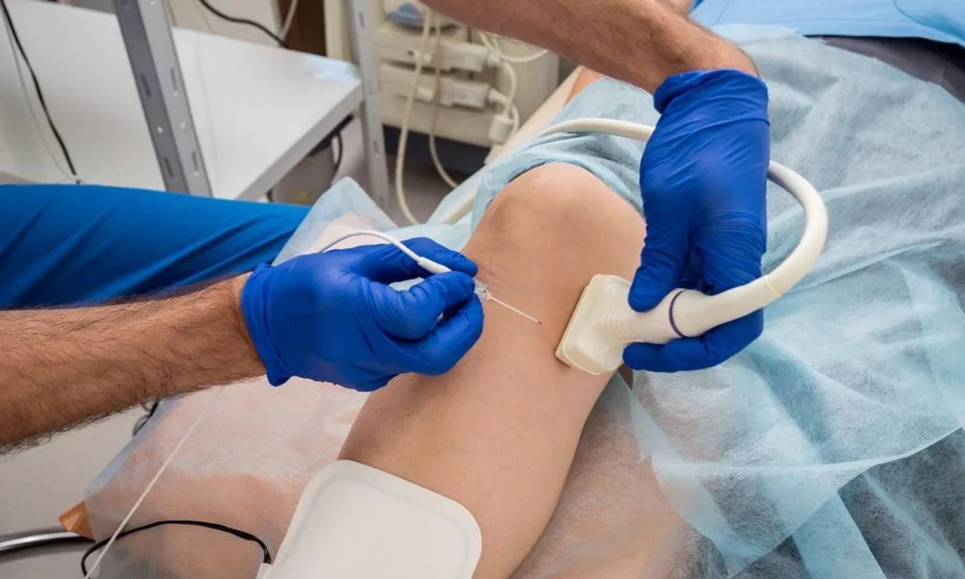 ¿Qué es la ablación láser endovenosa y cómo funciona paso a paso?
